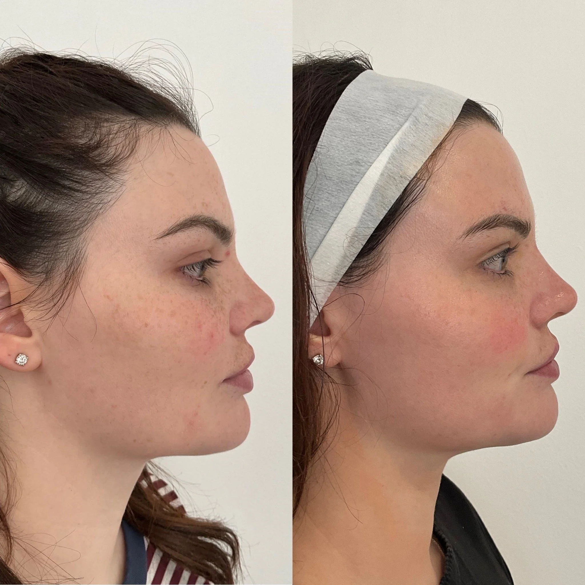 Side-by-side comparison of a woman's face showing improved skin condition on the right, with fewer freckles and redness, after skincare or treatment.
