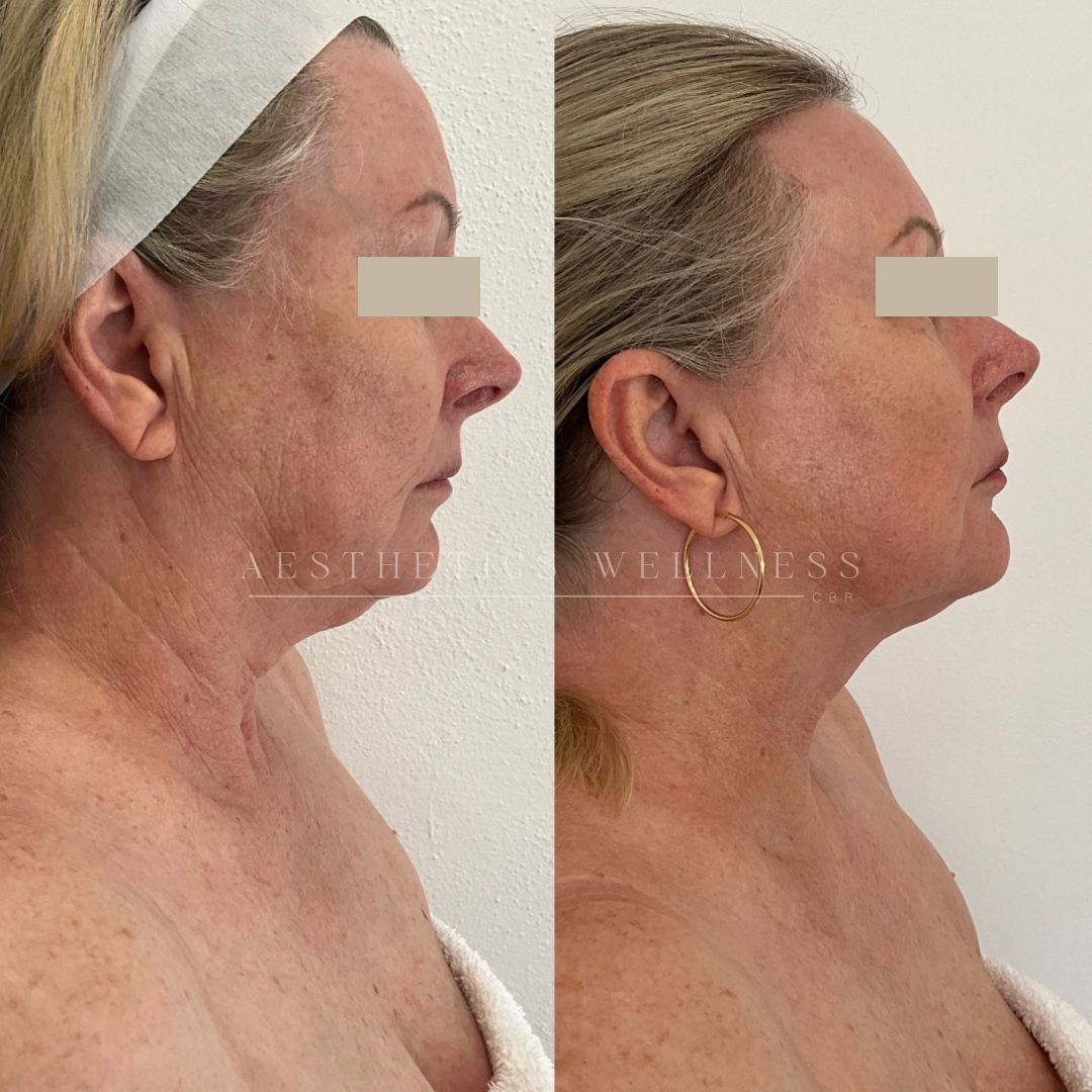 IPL before and after neck laxity and tighteing