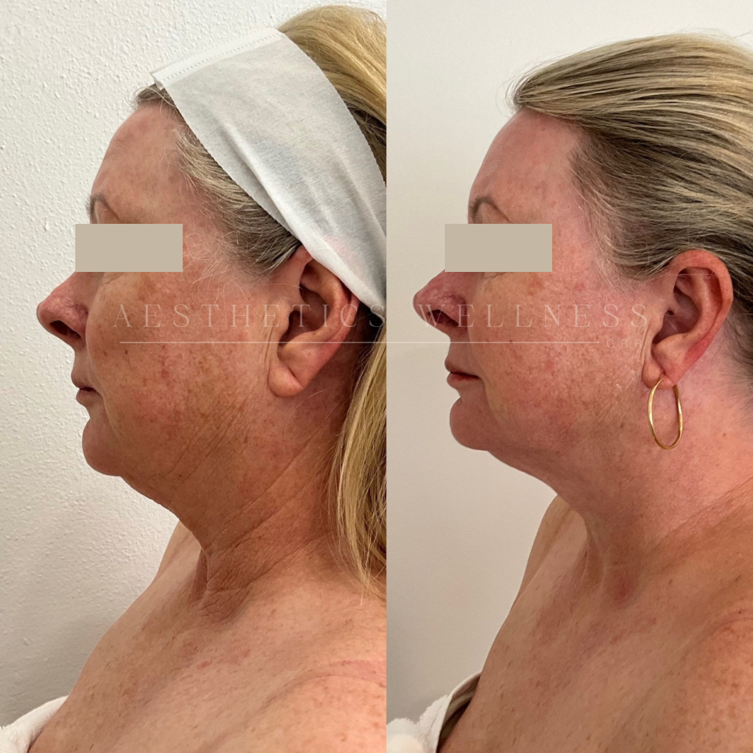 IPL pigment & redness removal before and after canberra