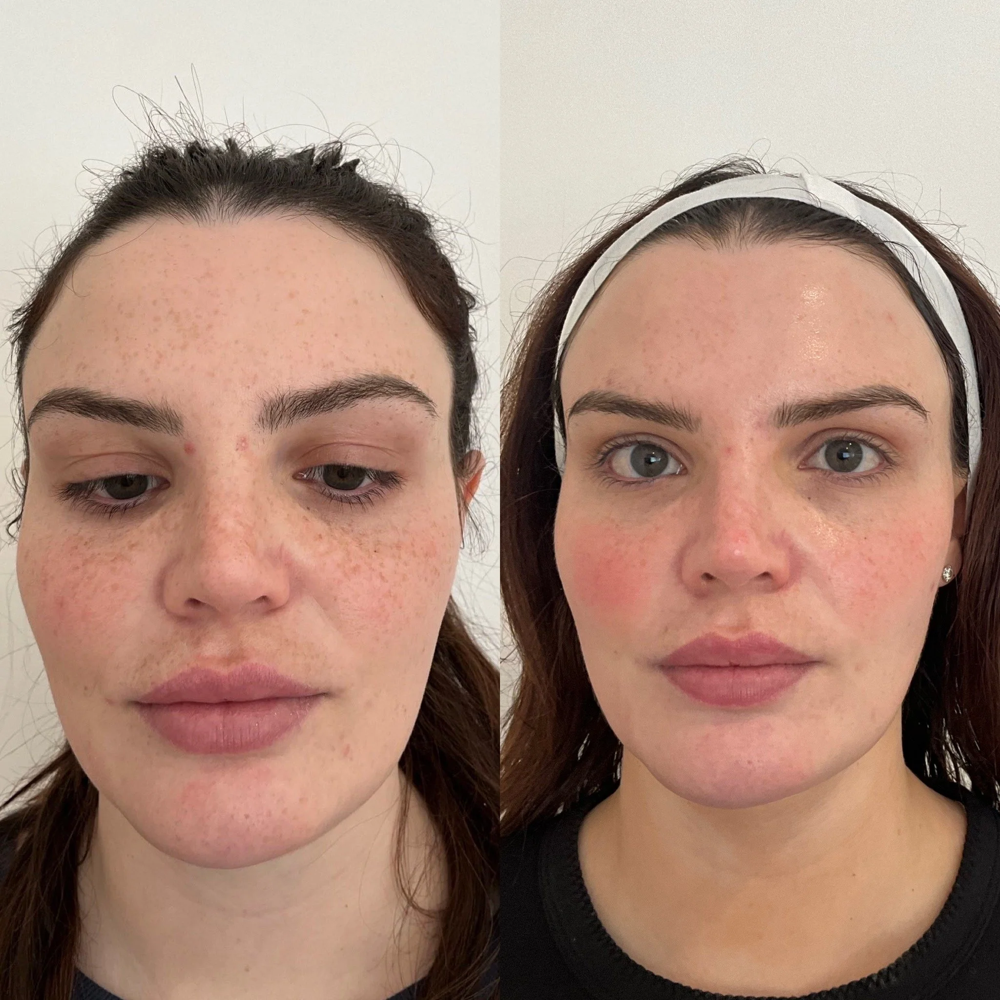Cosmelan before & after Canberra 2