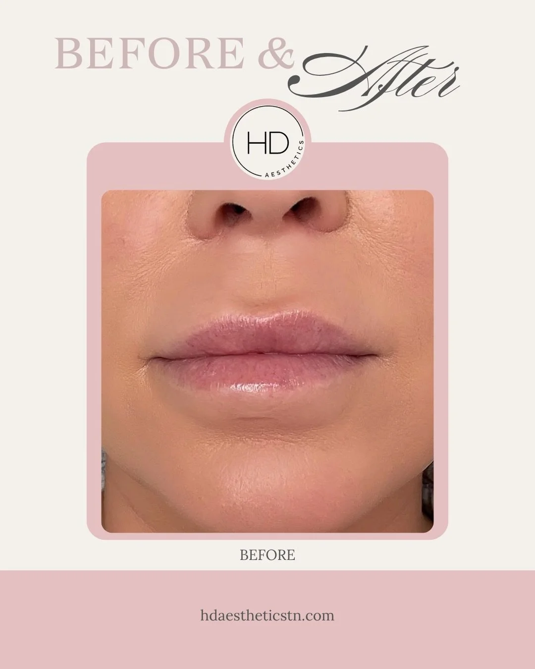 Before ➡️ After: Lip Blushing! ✨💋

Book Online 24/7
https://www.hdaestheticstn.com > Book Now
📞615-436-3696
🌐www.hdaestheticstn.com 
📍213 N Cumberland St 
Lebanon, TN 37087

#aestheticallyHD #lebanontn #lebanontnspa #medspa #lipblushing