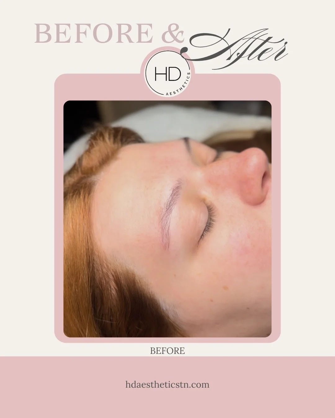 Before ➡️ After: PMU Brows! ✨

Book Online 24/7
https://www.hdaestheticstn.com > Book Now
📞615-436-3696
🌐www.hdaestheticstn.com 
📍213 N Cumberland St 
Lebanon, TN 37087

#aestheticallyHD #lebanontn #lebanontnspa #pmu #microblading