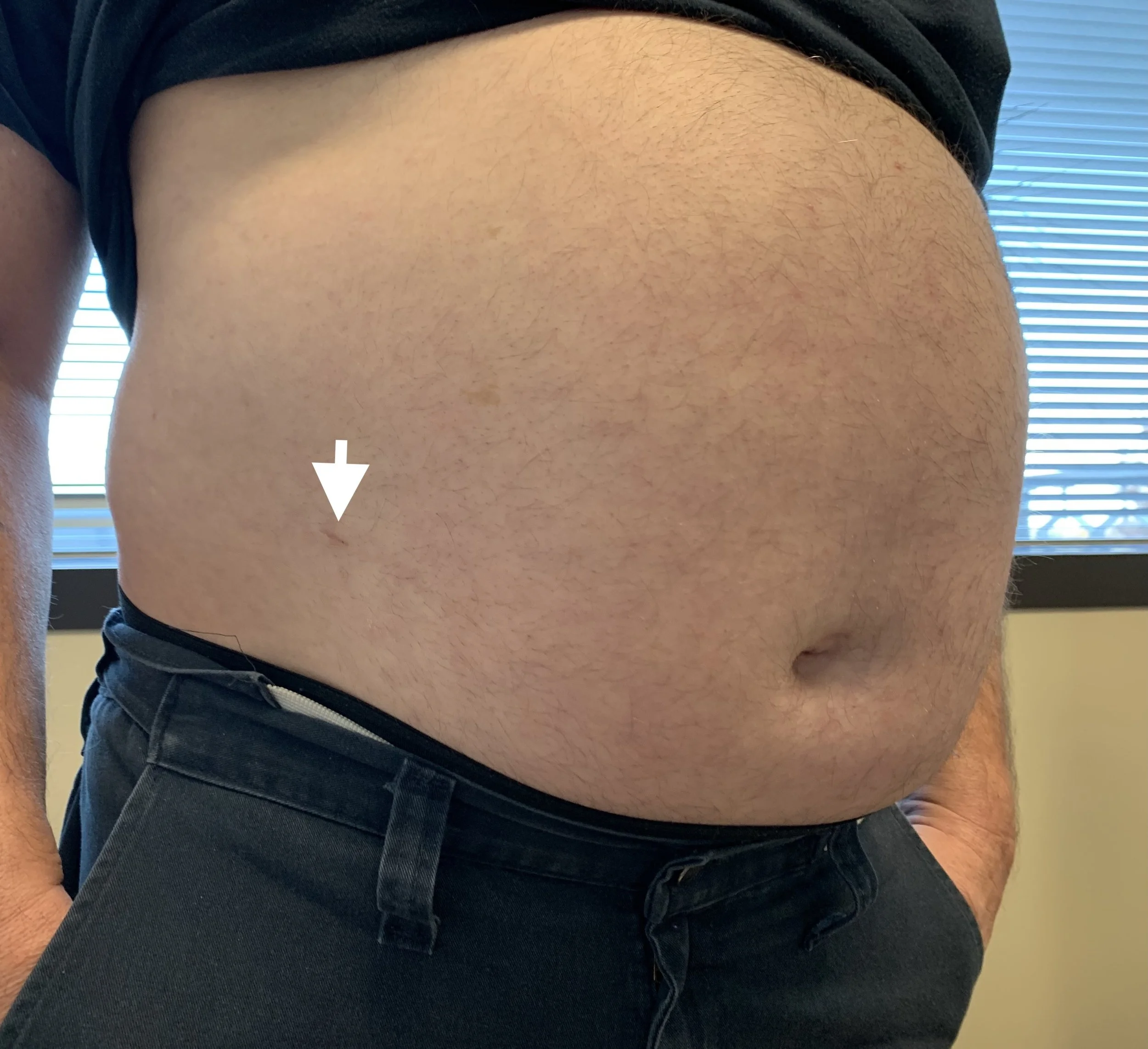 Image of a middle-aged man with three tiny, healed scars after robotic bilateral inguinal hernia repair.