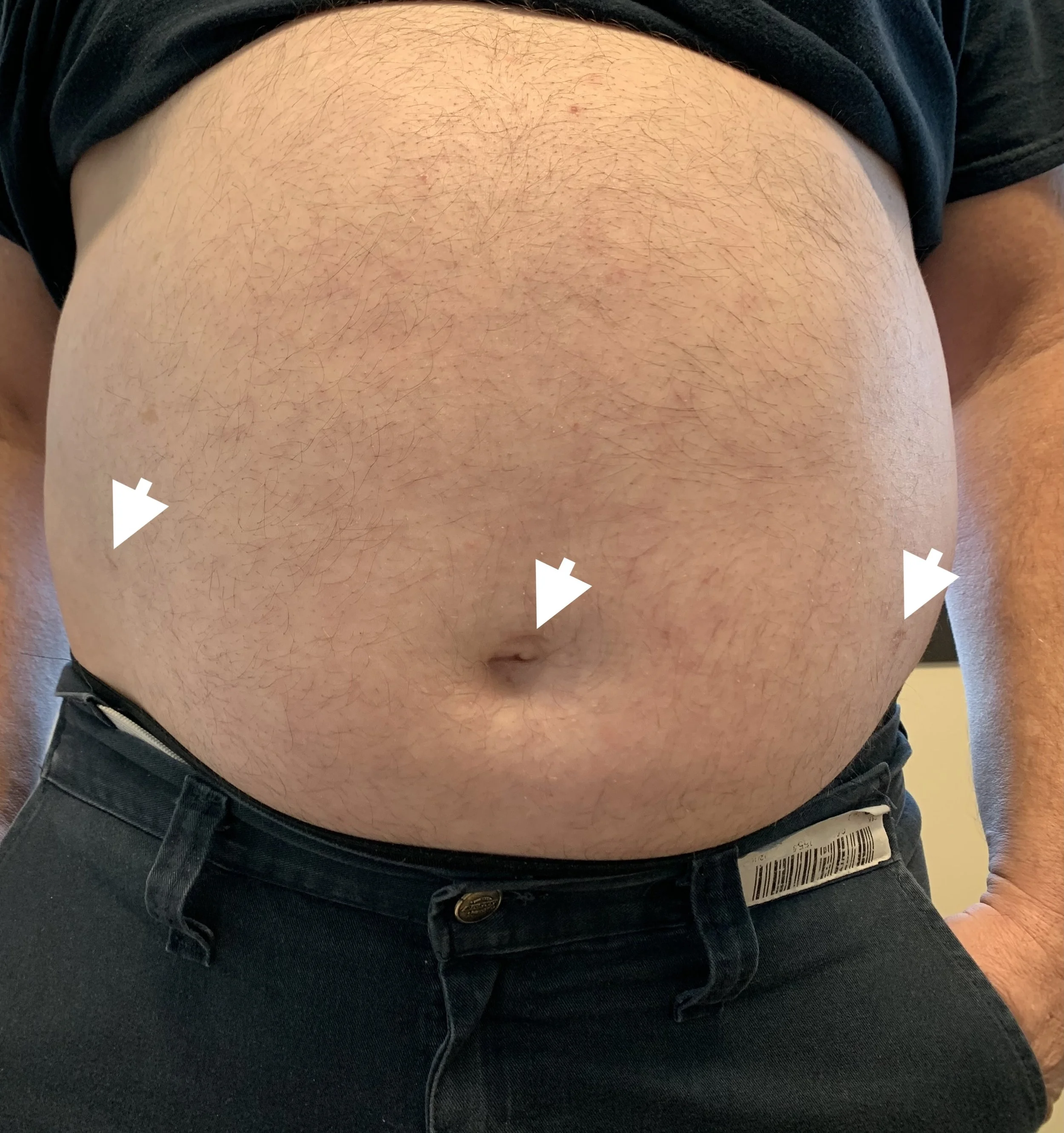 Photo showing minimal scarring of a middle-aged man following robotic surgery for bilateral inguinal hernia repair.