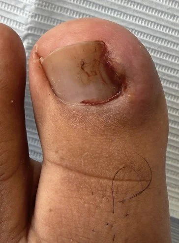 Close-up of a toe with a large, painful ingrowing toenail