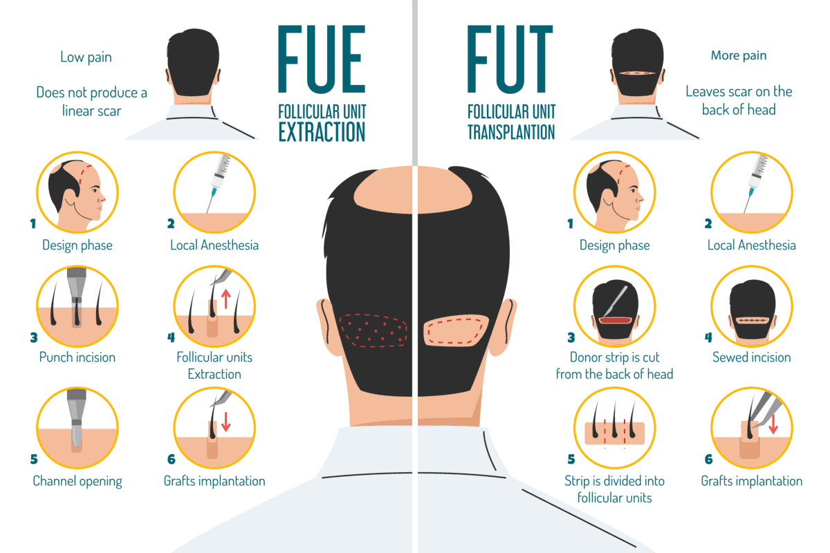 A Guide To Modern Hair Replacement Options Transplants Toupees And A Guide To Modern Hair Replacement Options Transplants Toupees And