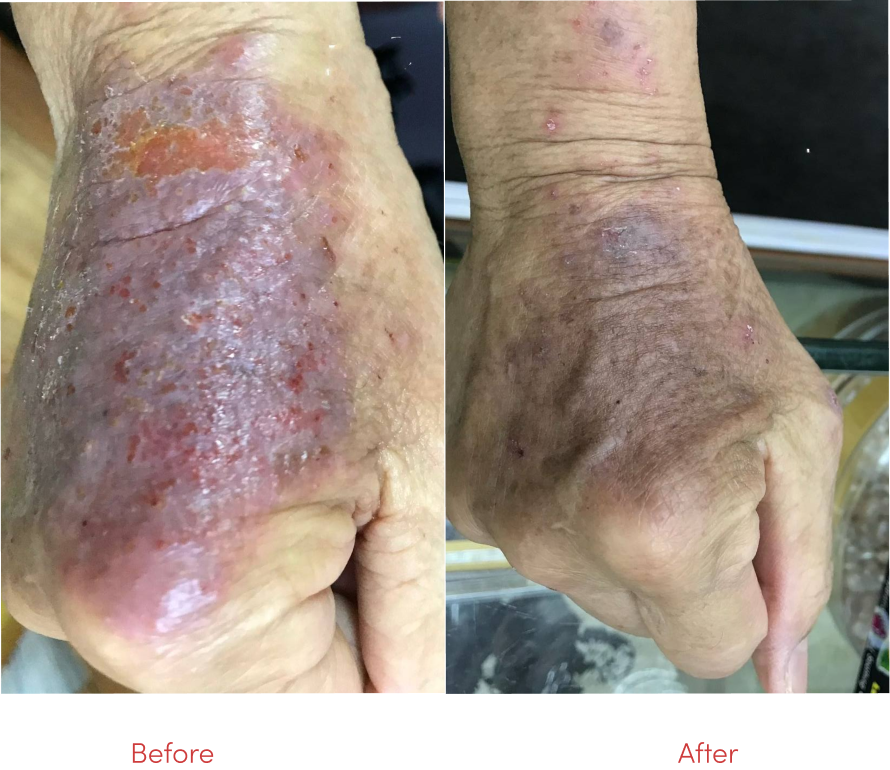 Eczema treatment before and after results at Fujian TCM Singapore