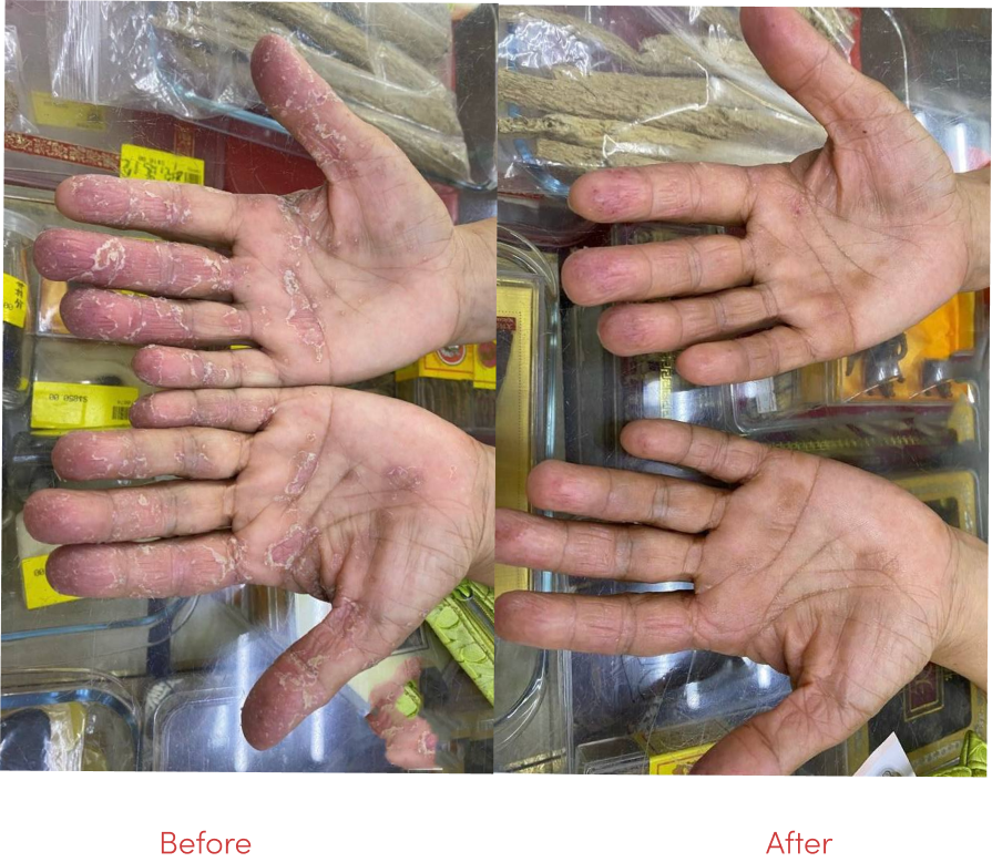 Eczema skin improvement before and after TCM treatment at Fujian TCM Singapore