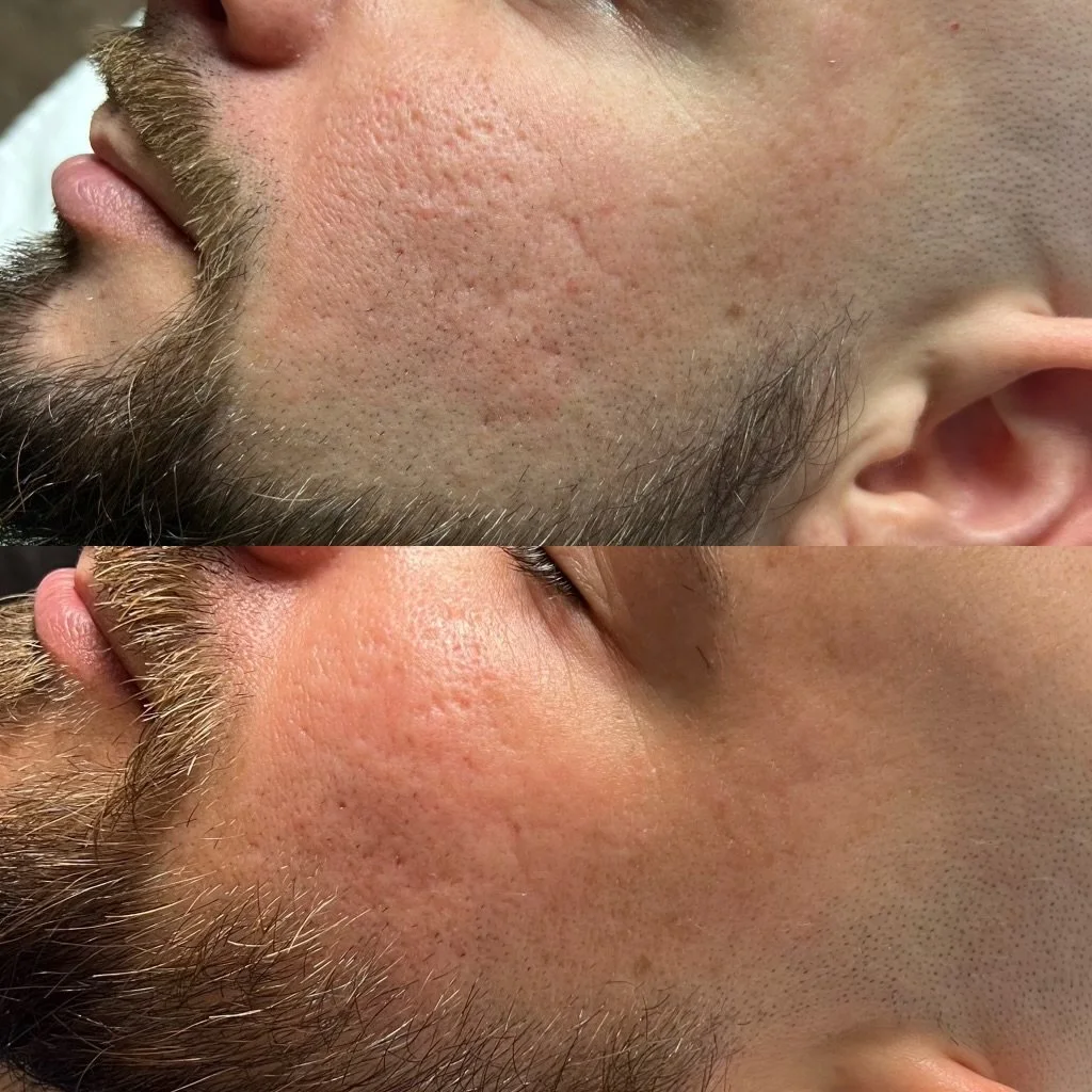 Micro-needling