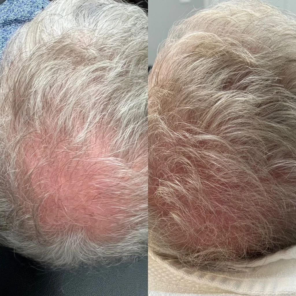 Hair Restoration