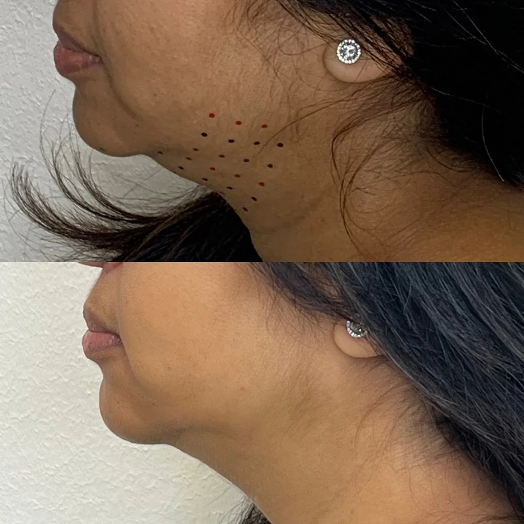 Kybella