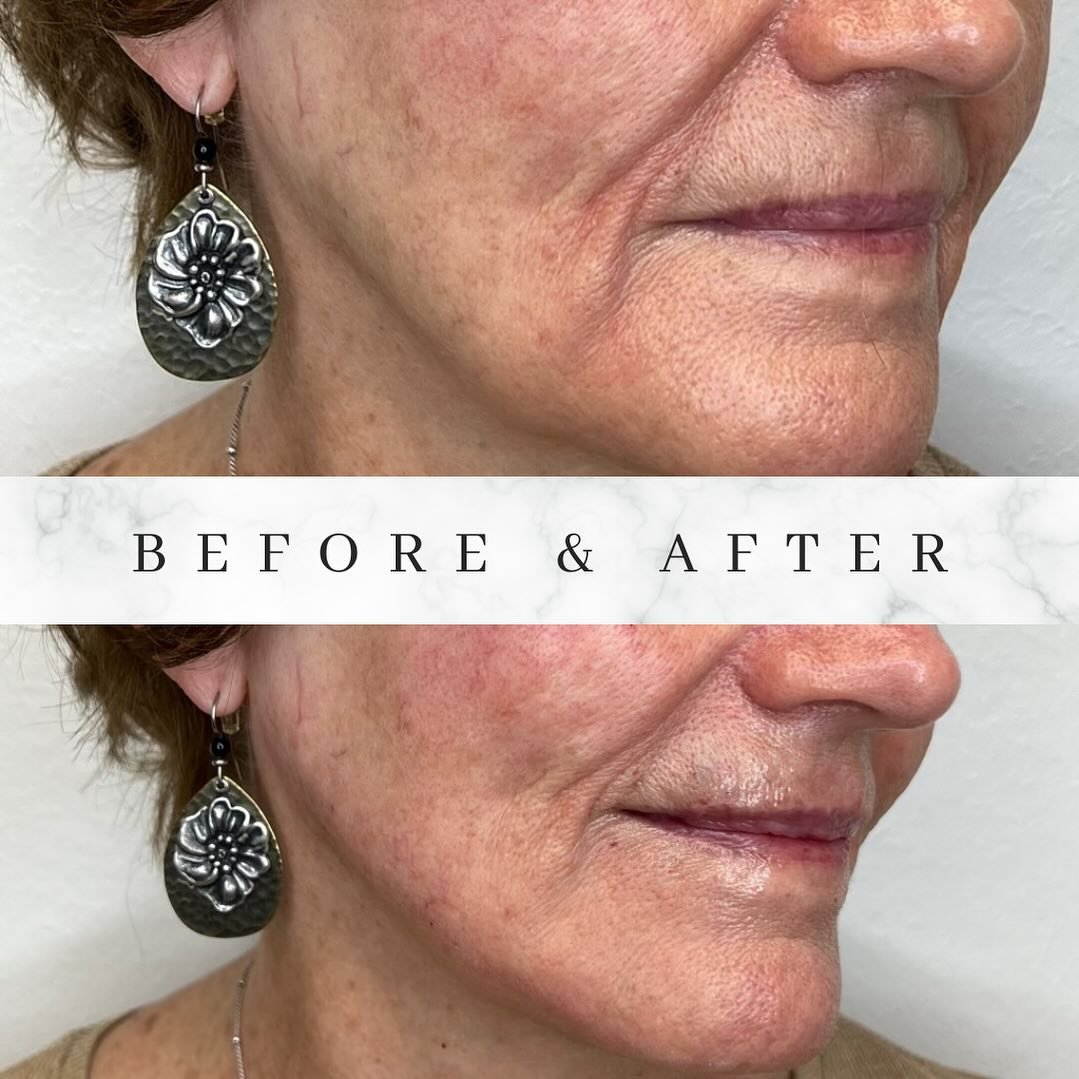 Volux and Voluma are great combination for snatched jawlines! Let us create a custom medical aesthetic package for your skin goals! 

#filler #botox #injector