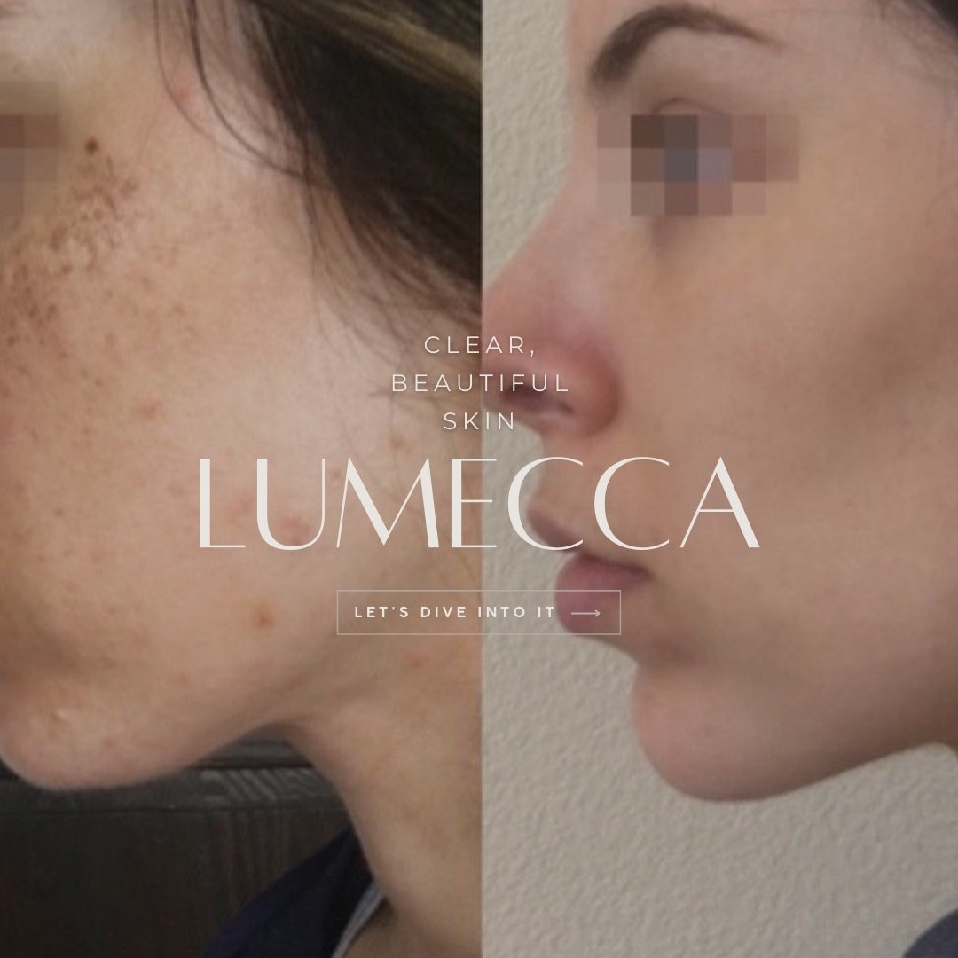 Discover Why We Love LUMECCA So Much! It's the &quot;magic eraser&quot; laser therapy service we now offer at @bryan_medical_wellness 

Swipe to see more about our latest offering. 

#bryanmwkernersville #Inmodelaunch #Inmode #skincare #medspa #radio