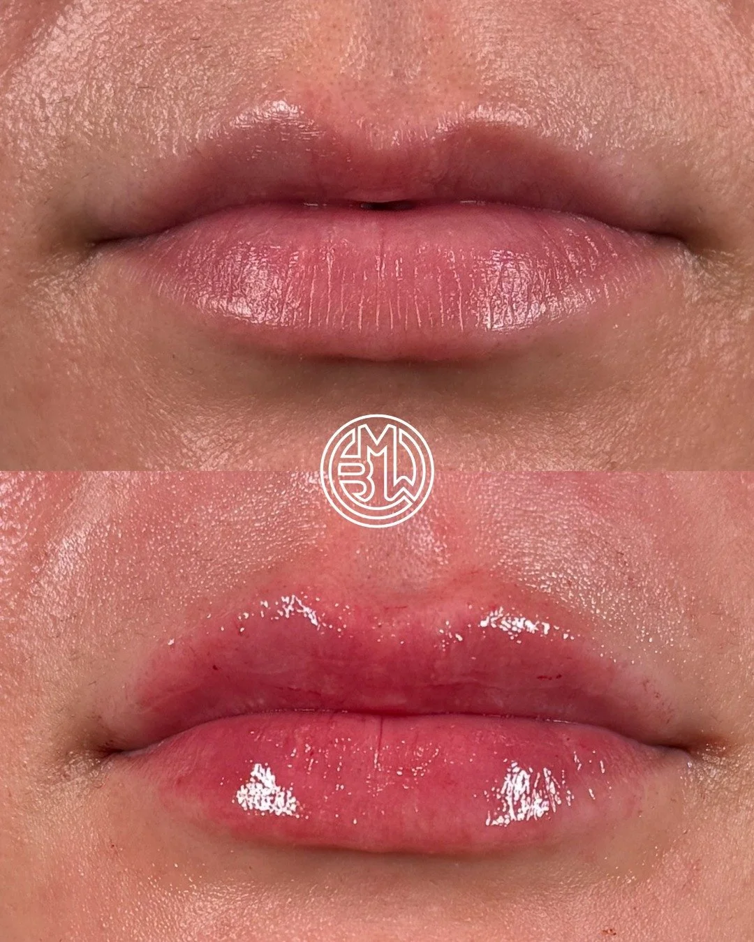 Subtle. Balanced. Beautiful.
This before and after showcases how precise lip injections can enhance volume and shape while maintaining natural proportions. Results tailored to your features.
#LipEnhancement #AestheticMedicine #BeforeAndAfterFiller #L