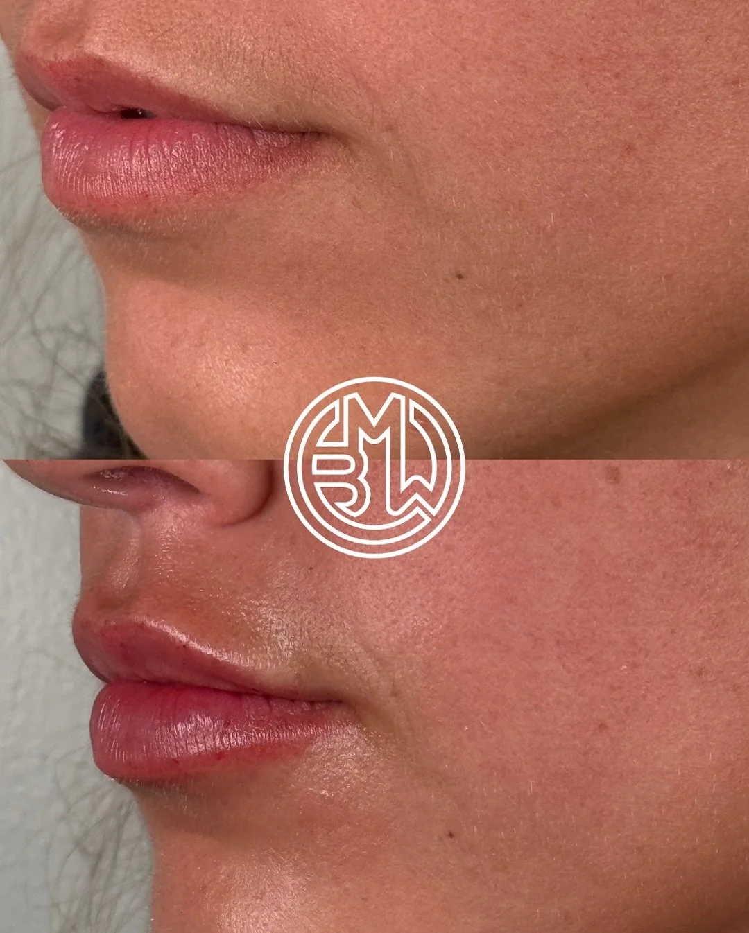 A pretty pout just in time for the weekend! 
1/2 syringe Juvederm XC Ultra 
Provider: Daniel @the_good_pa 

Bryan Medical &amp; Wellness 
200 South Main Street 
Kernersville, NC

(336) 992-0491