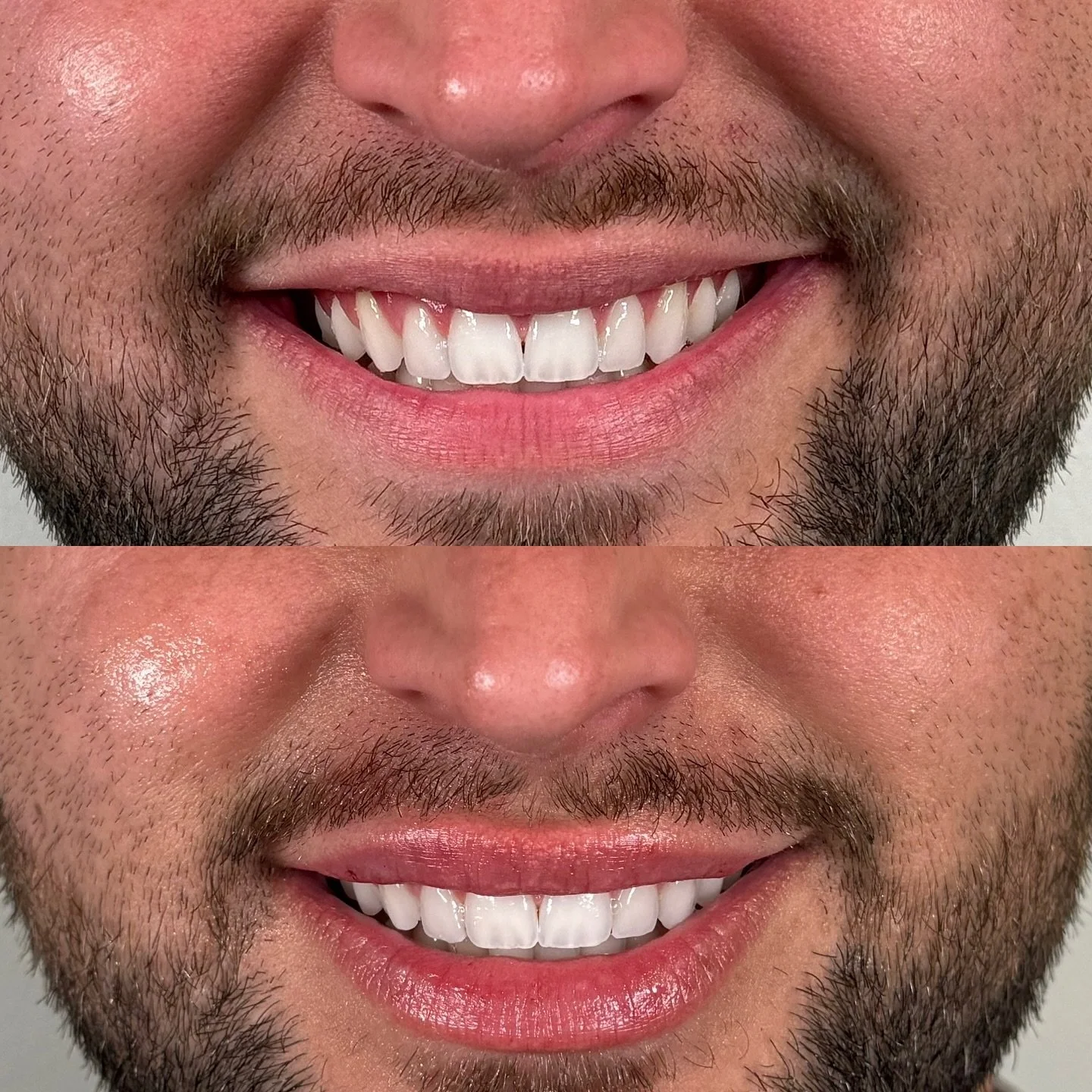 Subtle boost, major confidence 💪
Natural never looked so good. 

Bryan Medical &amp; Wellness 
200 South Main Street 
Kernersville, NC

Injectors:
@the_good_pa 
@balancedbycharlotte 

Aesthetician: 
@blaruebeauty 

#KVegas #WinstonSalemNC #TriadMedS