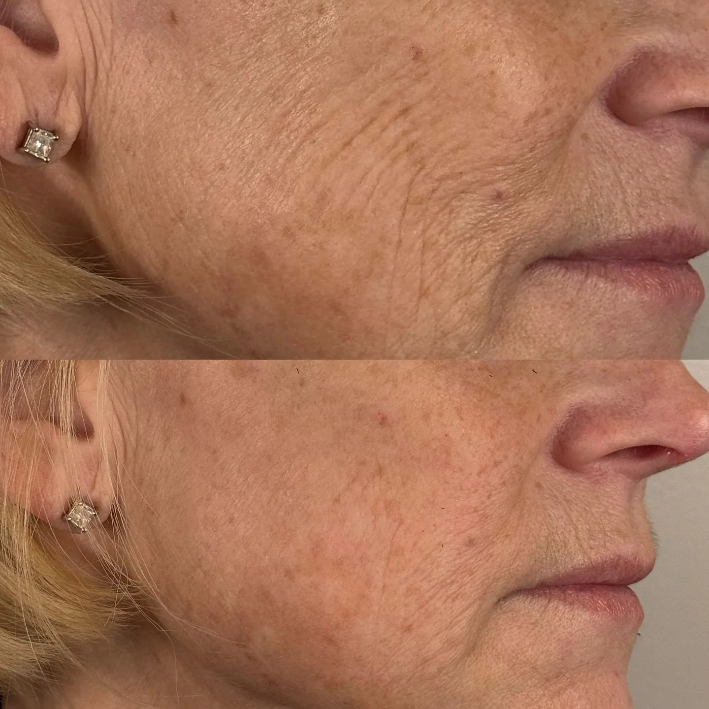 SO SMOOTH WITH SKINVIVE! 

Skinvive is a hyaluronic acid (HA) injectable treatment designed to improve skin hydration, texture, and radiance. 

How It Works: 

Skinvive is injected as microdroplets into the skin, where it works to: 

💦Increase HA le