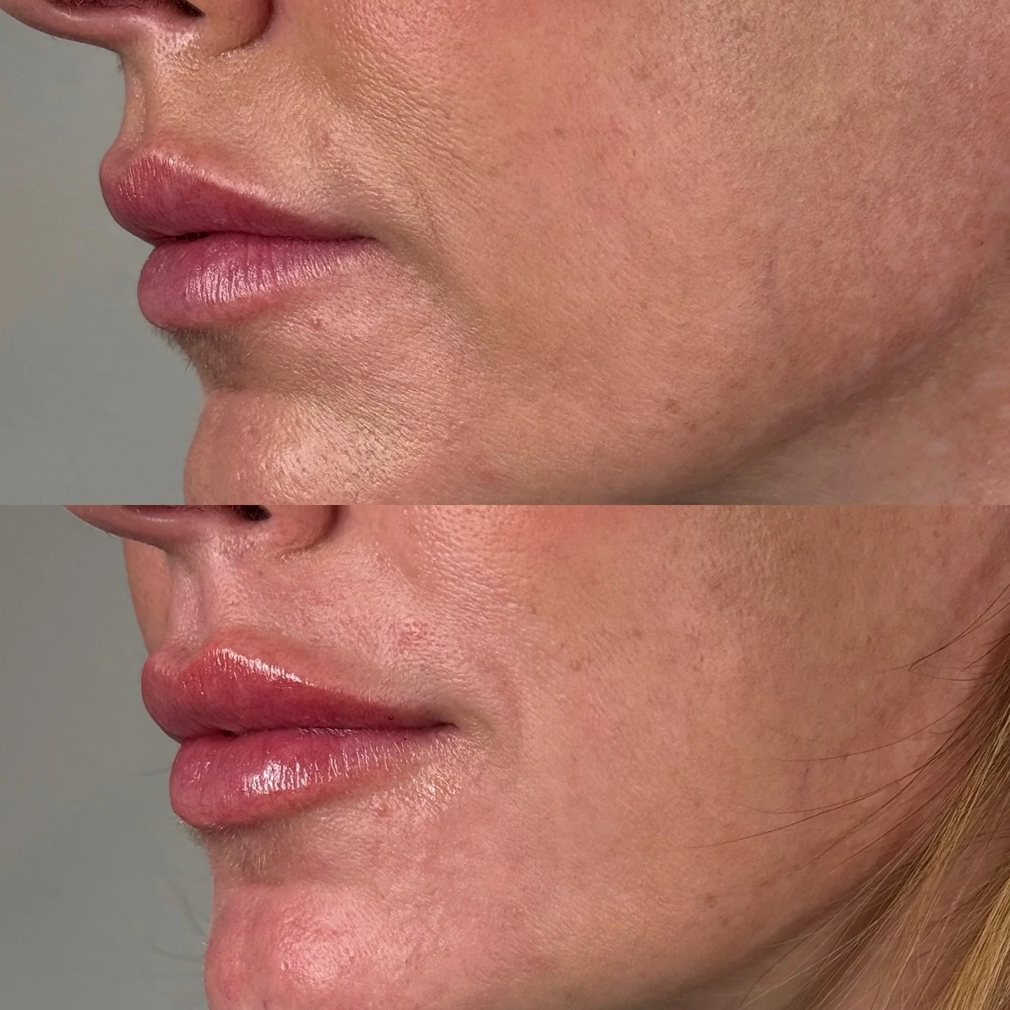 Just 1 syringe of Skinvive.
No volume replacement&mdash;simply clean, lasting hydration.

A subtle lip-gloss skin finish that looks refreshed.

Results that hold for 6&ndash;12 months.

Bryan Medical &amp; Wellness 
200 South Main Street
Kernersville