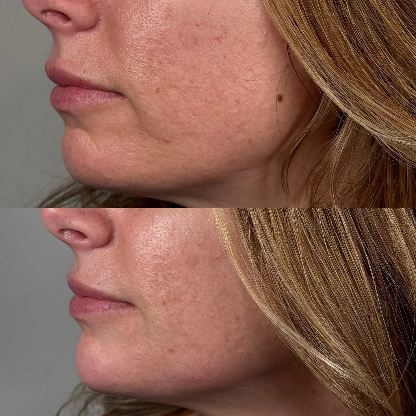 Lifting shadows, defining curves.
2 syringes of Voluma for a subtle, sculpted glow-up.

Bryan Medical &amp; Wellness 
200 South Main Street 
Kernersville NC

Injectors:
@the_good_pa 
@balancedbycharlotte 

Aesthetics
@blaruebeauty
