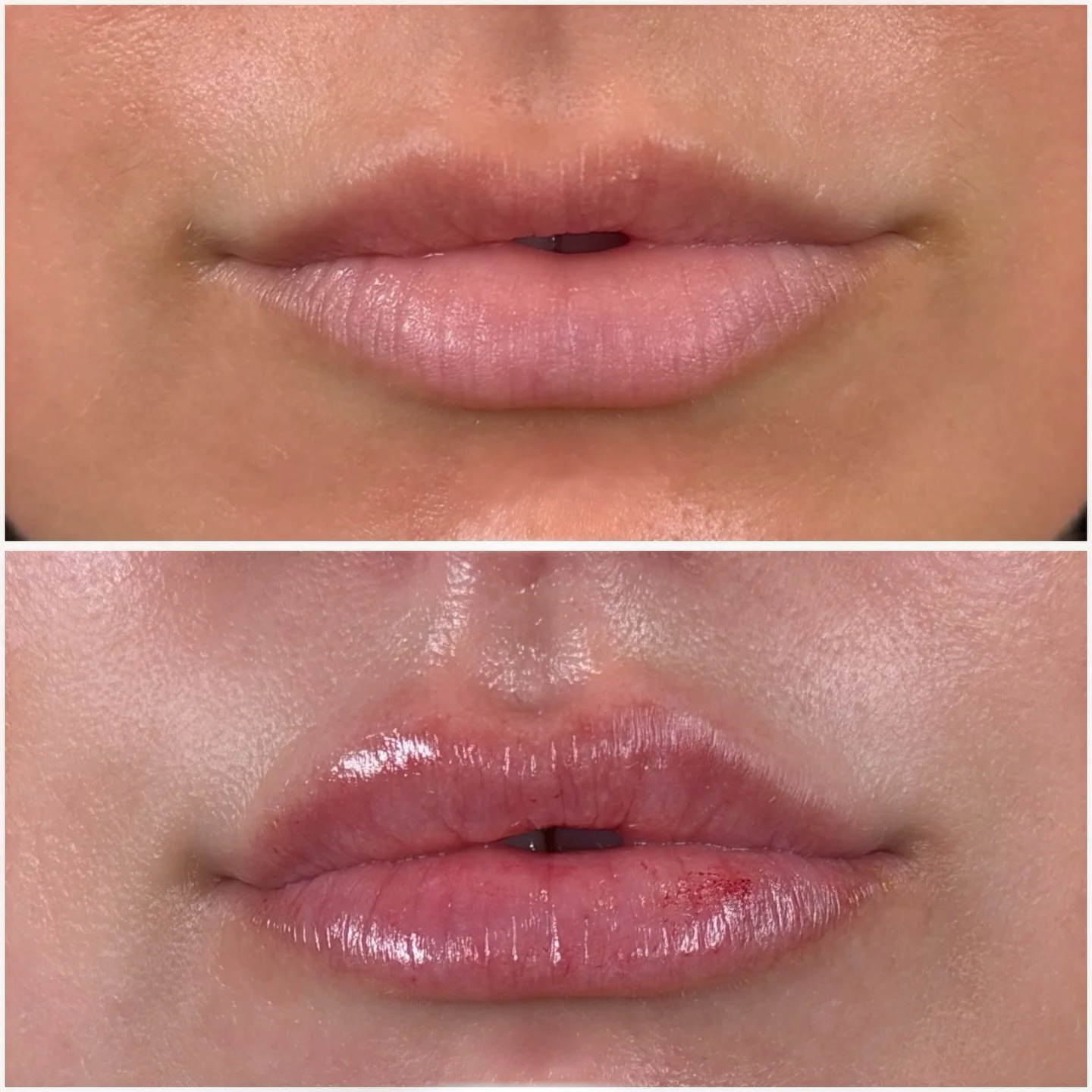 1.25 syringe of fresh Skinvive hydration, because when the temp drops chapstick doesn&rsquo;t cut it! 

Book your holiday appointment or grab your gift card so you can be soft, smooth, and hydrated all winter long:) 

Bryan Medical &amp; Wellness 
20