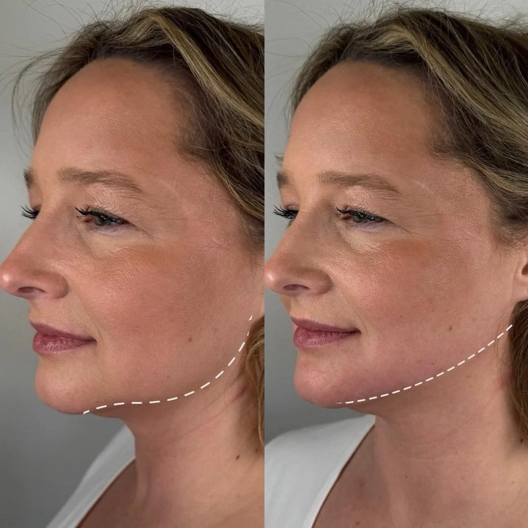 Subtle tweaks. Major confidence. 

Jawline and chin filler to restore definition, soften jowl shadows, and gently lift sagging&mdash;without changing her. Just a refreshed profile.

Bryan Medical &amp; Wellness
200 South Main Street
Kernersville, NC
