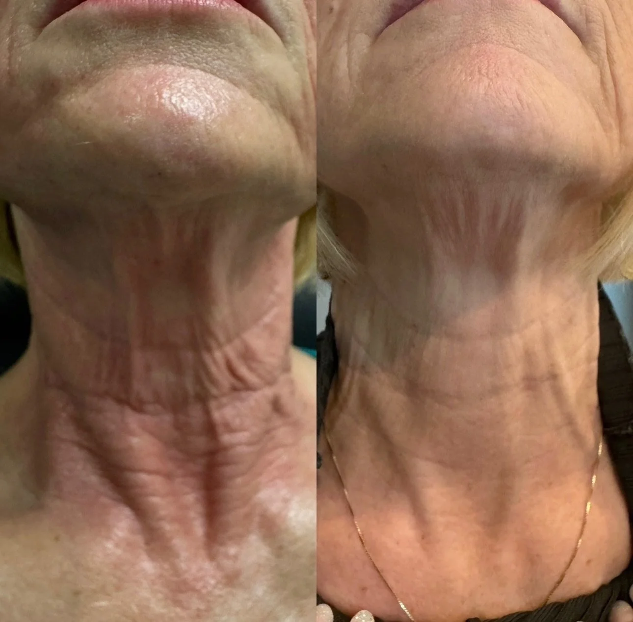 Three sessions. One seriously snatched neck. 

Morpheus8 works below the surface to tighten, smooth, and stimulate collagen where it counts&mdash;because your jawline deserves just as much attention as your face.

Consistency is the secret&hellip; an