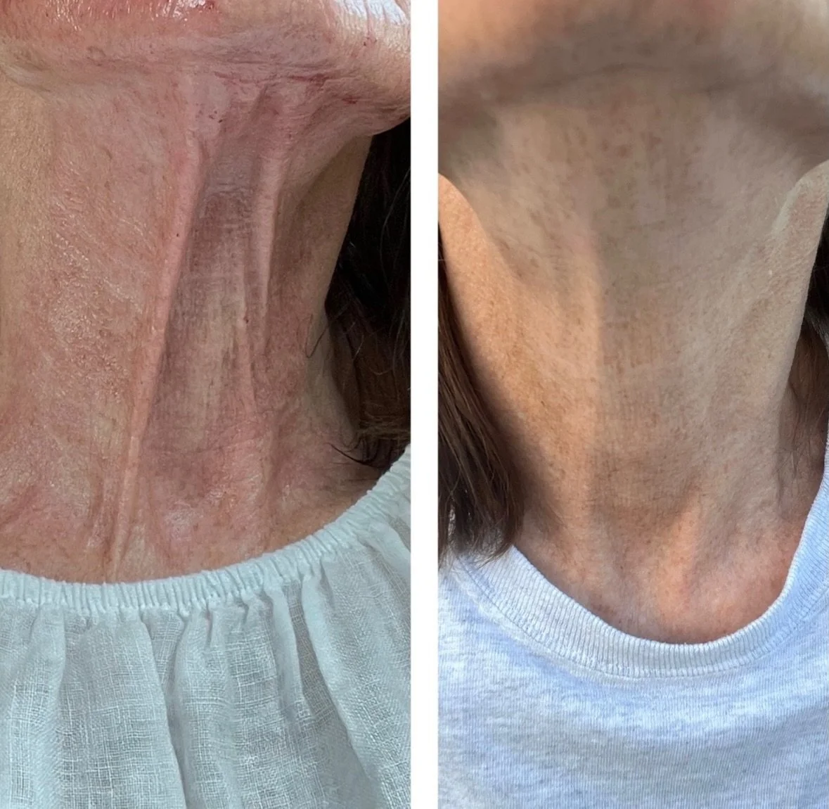 So SMOOTH! Morpheus8 goes deep, bringing you the smooth results you&rsquo;re looking for! Start now, to be summer ready. 

Book online BryanMW.com (link in bio)
Or call: (336) 992-0491

Bryan Medical &amp; Wellness
200 South Main Street
Kernersville,