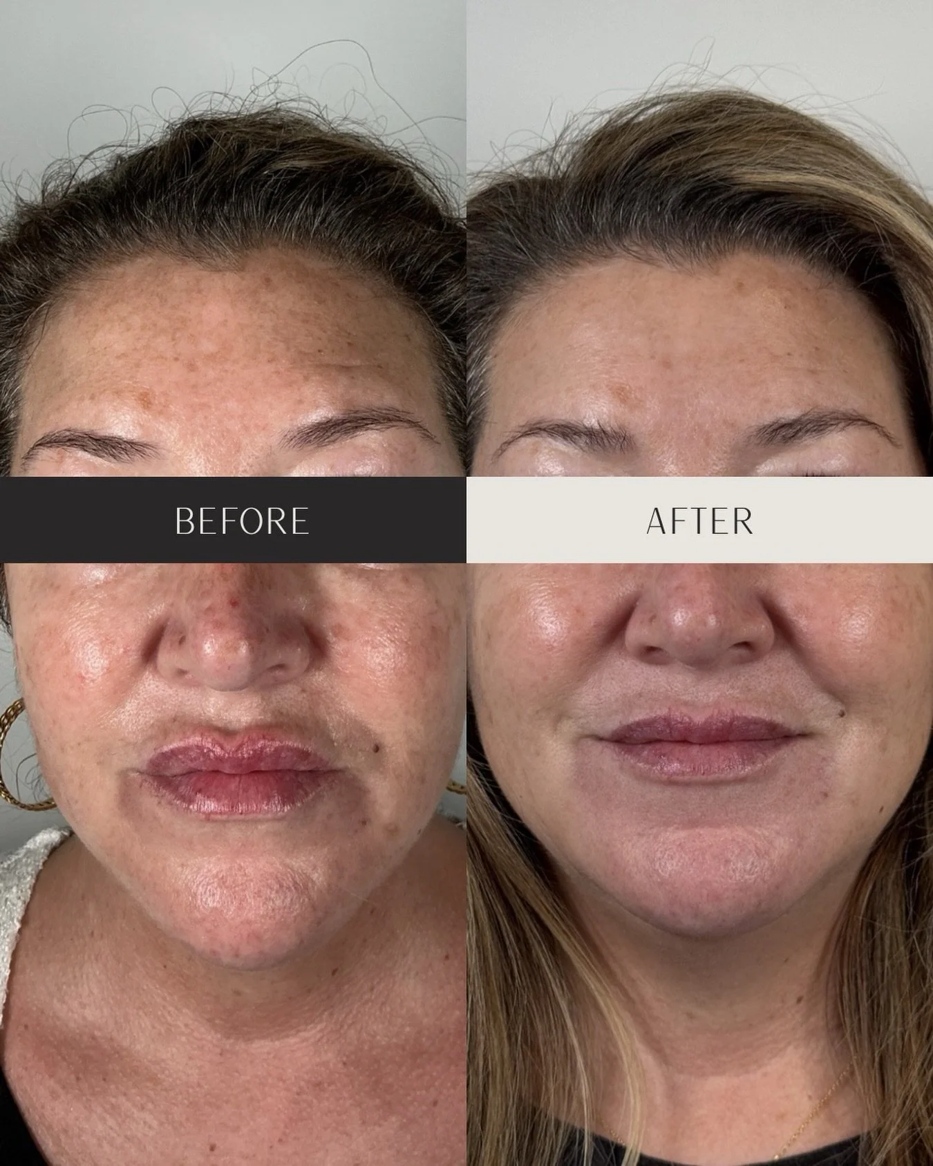 Want to clear up age spots and uneven skin, but not ready to invest in laser therapy? 

Microneedling and chemical peels are powerful, clinically backed treatments that target uneven tone, age spots, and texture at the surface level, helping your ski