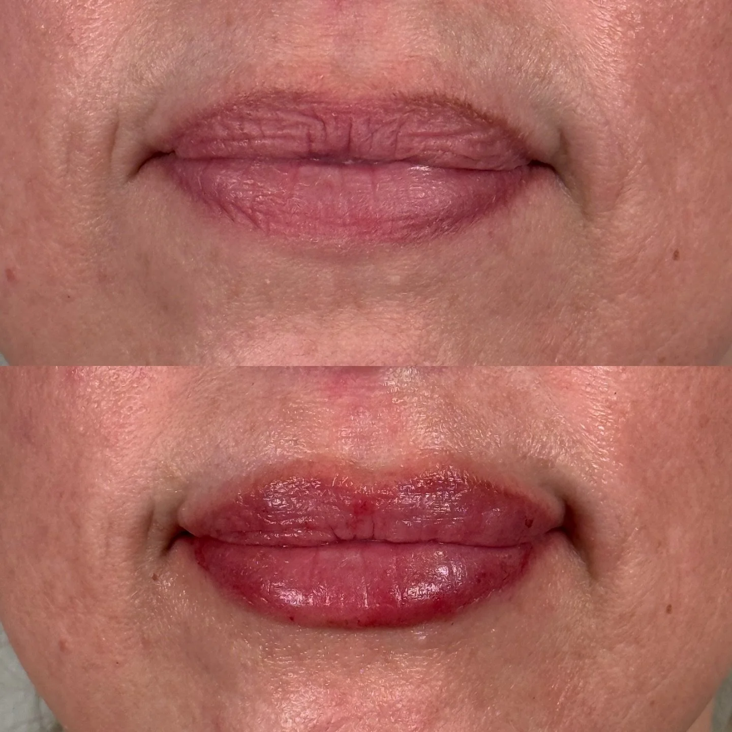 Just 1 syringe Juvederm Ultra XC for subtle volume and hydration. We love a pretty pout in the middle of the week! 

Book online BryanMW.com (link in bio)
Or call: (336) 992-0491

Bryan Medical &amp; Wellness
200 South Main Street
Kernersville, NC

P