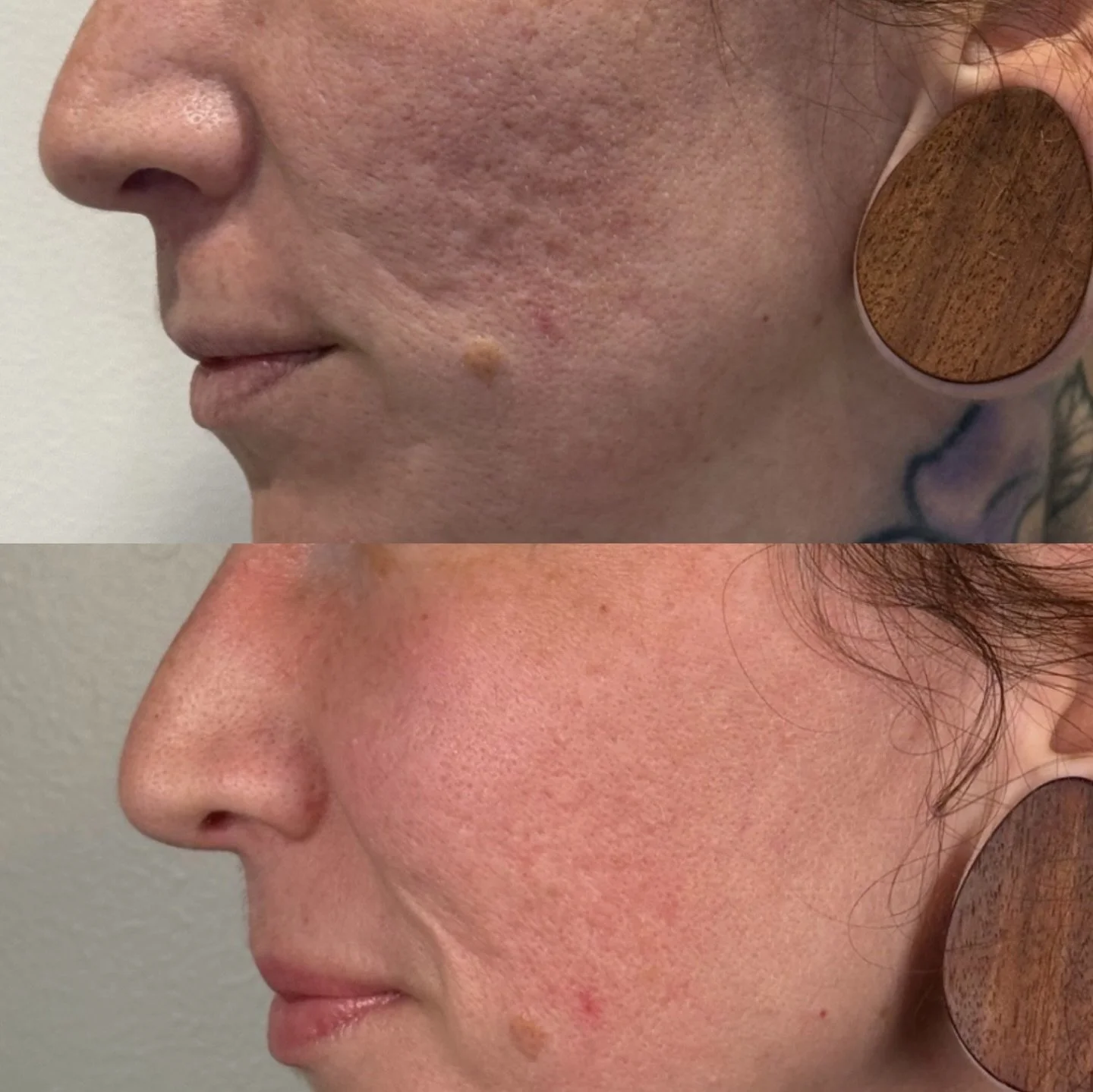 Morpheus8 Before and After.

It combines microneedling with radiofrequency energy to go deeper than surface treatments, stimulating collagen and tightening skin from within.

Think smoother texture, softer fine lines, and a firmer, more lifted look o