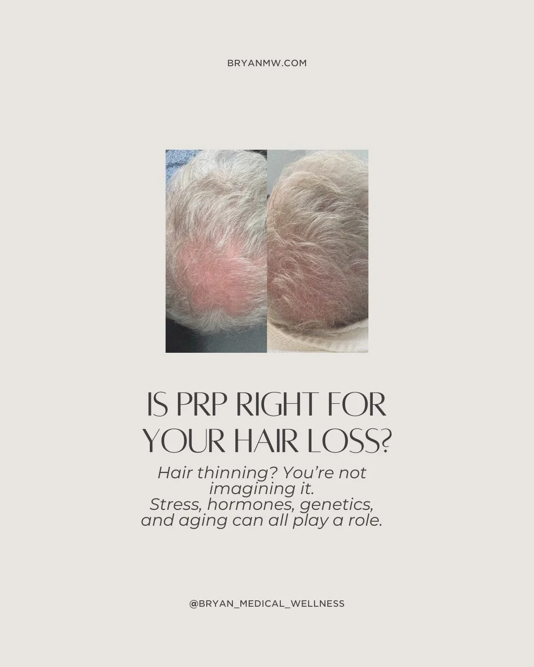 Hair thinning doesn&rsquo;t need a dramatic overhaul. 

PRP uses your body&rsquo;s own growth factors to support stronger, healthier hair at the root. Subtle, effective, and actually backed by science.

If you&rsquo;ve been noticing the change, it&rs