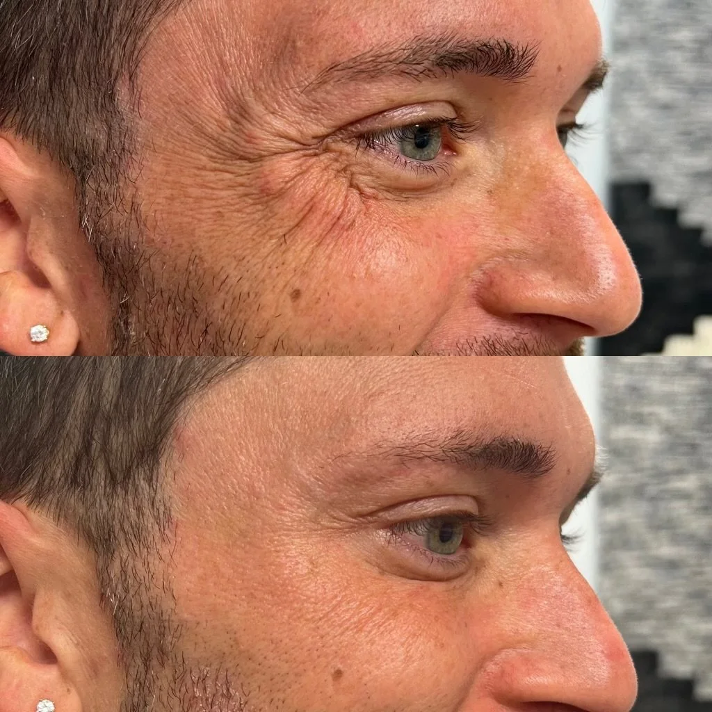 Close-up side view of a man's face showing the area around his eye, with visible skin texture and fine hair growth.