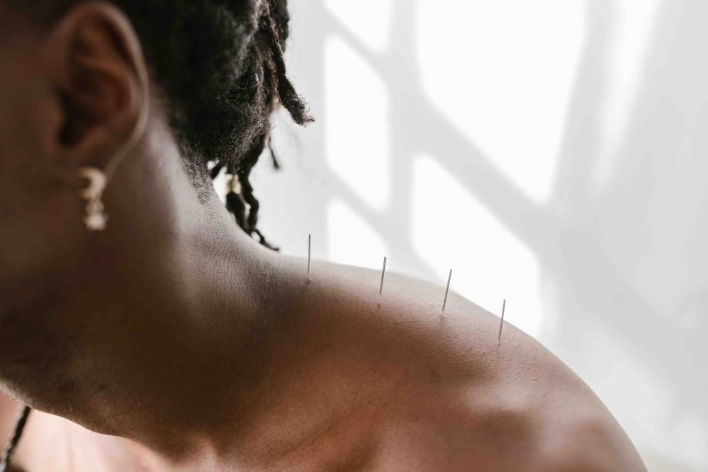 Acupuncture for Perimenopause