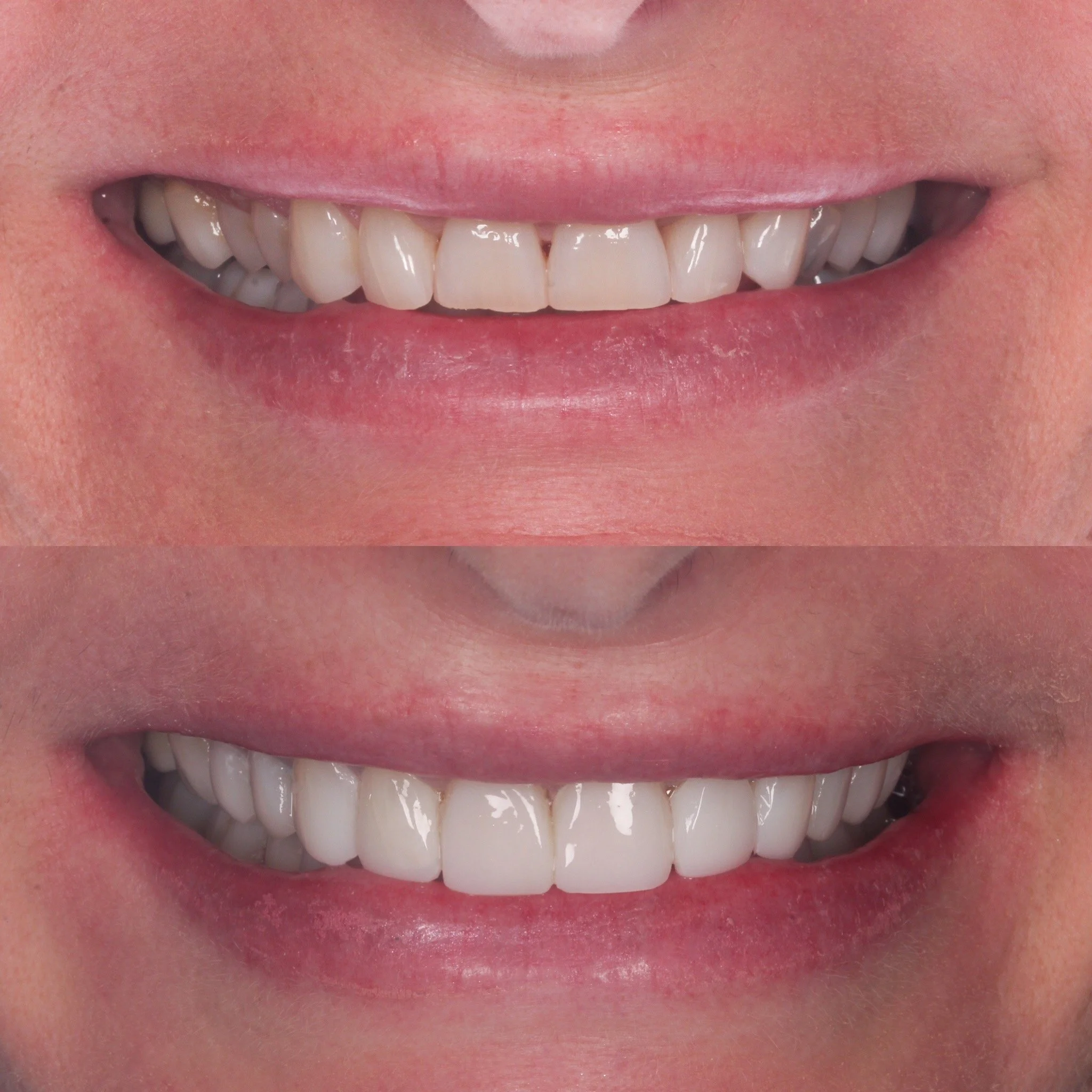 Composite Bonding Galway Dental Group