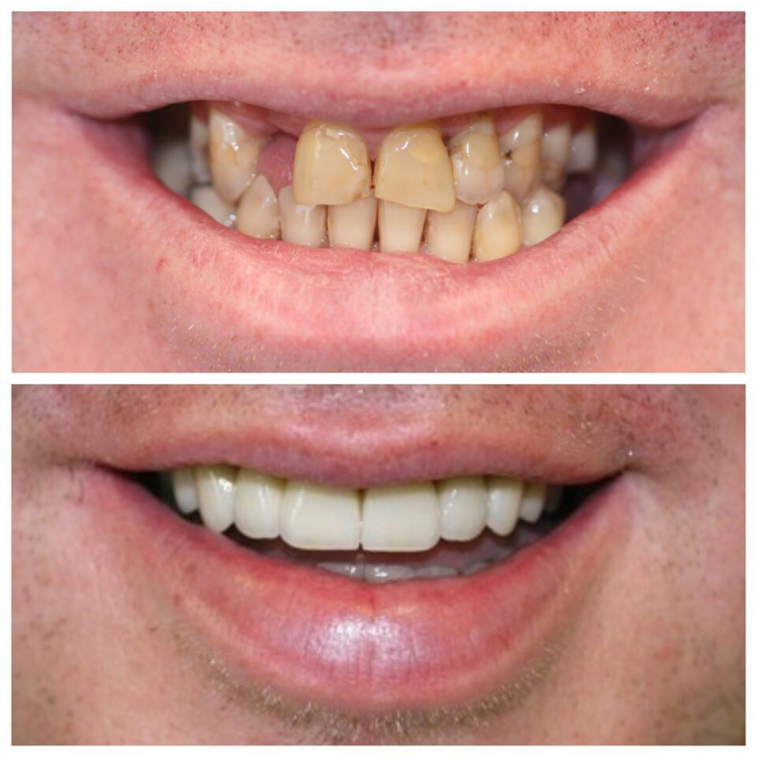 Porcelain crowns and veneers Galway Dental Group
