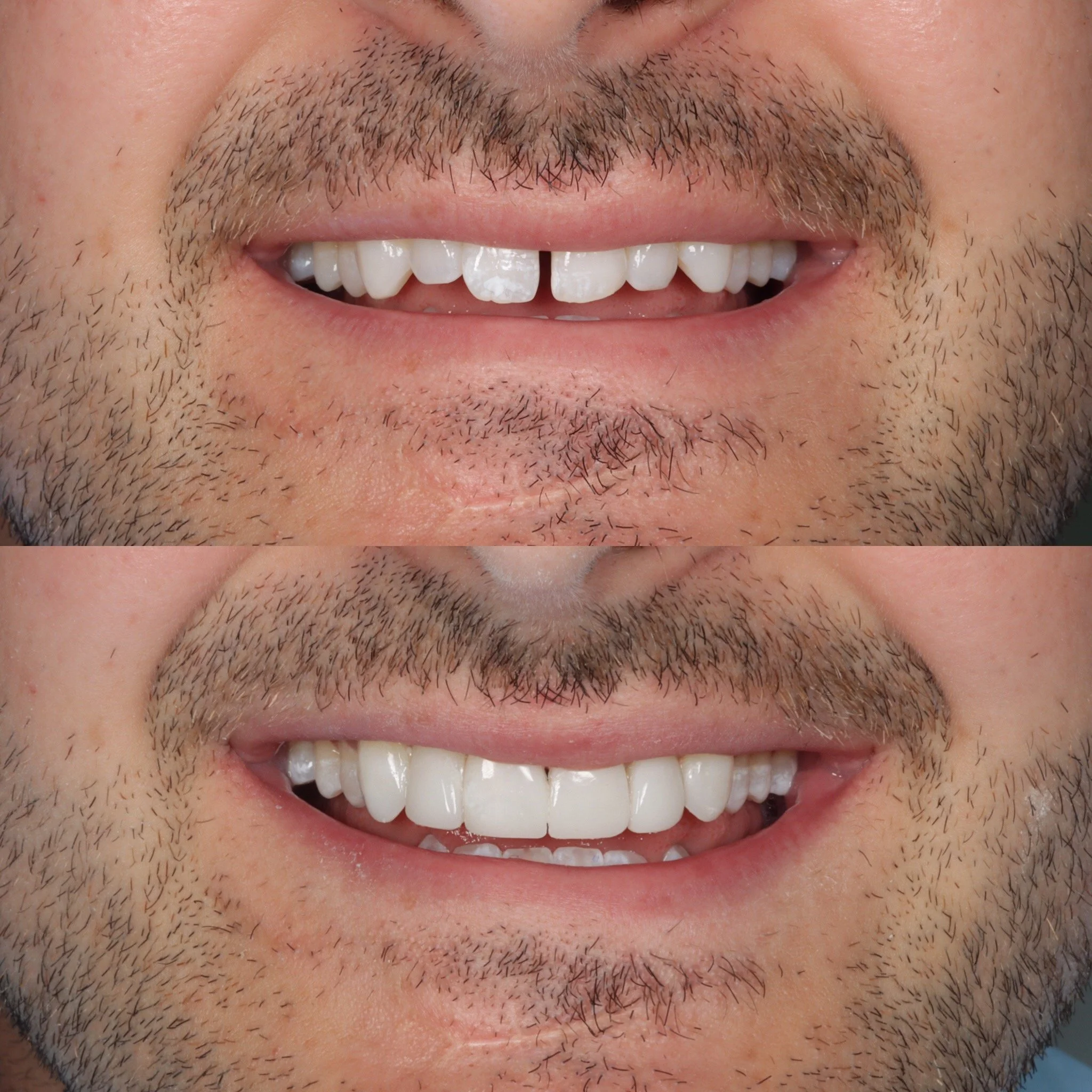 Composite Bonding Galway Dental Group