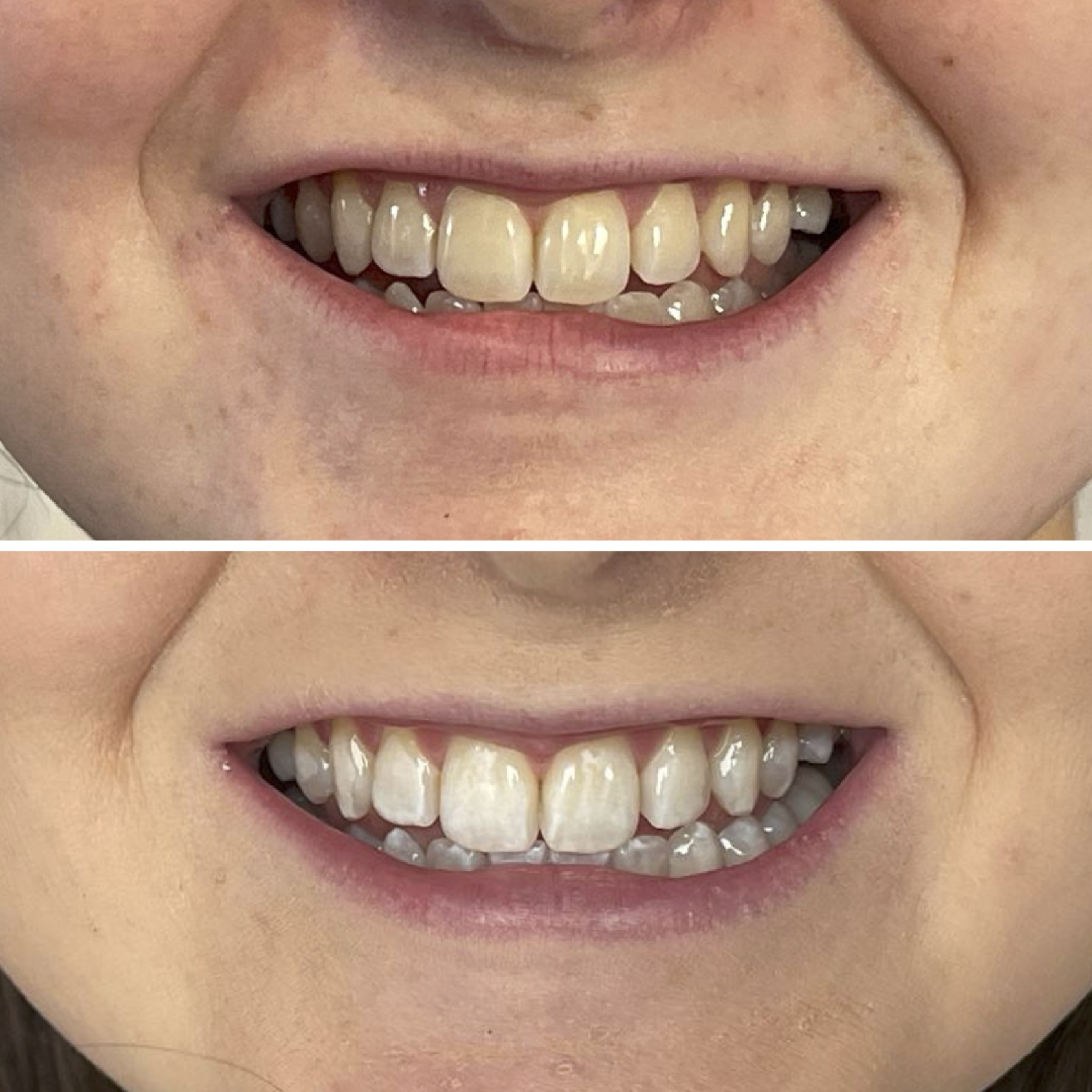 Teeth Whitening Galway Dental Group
