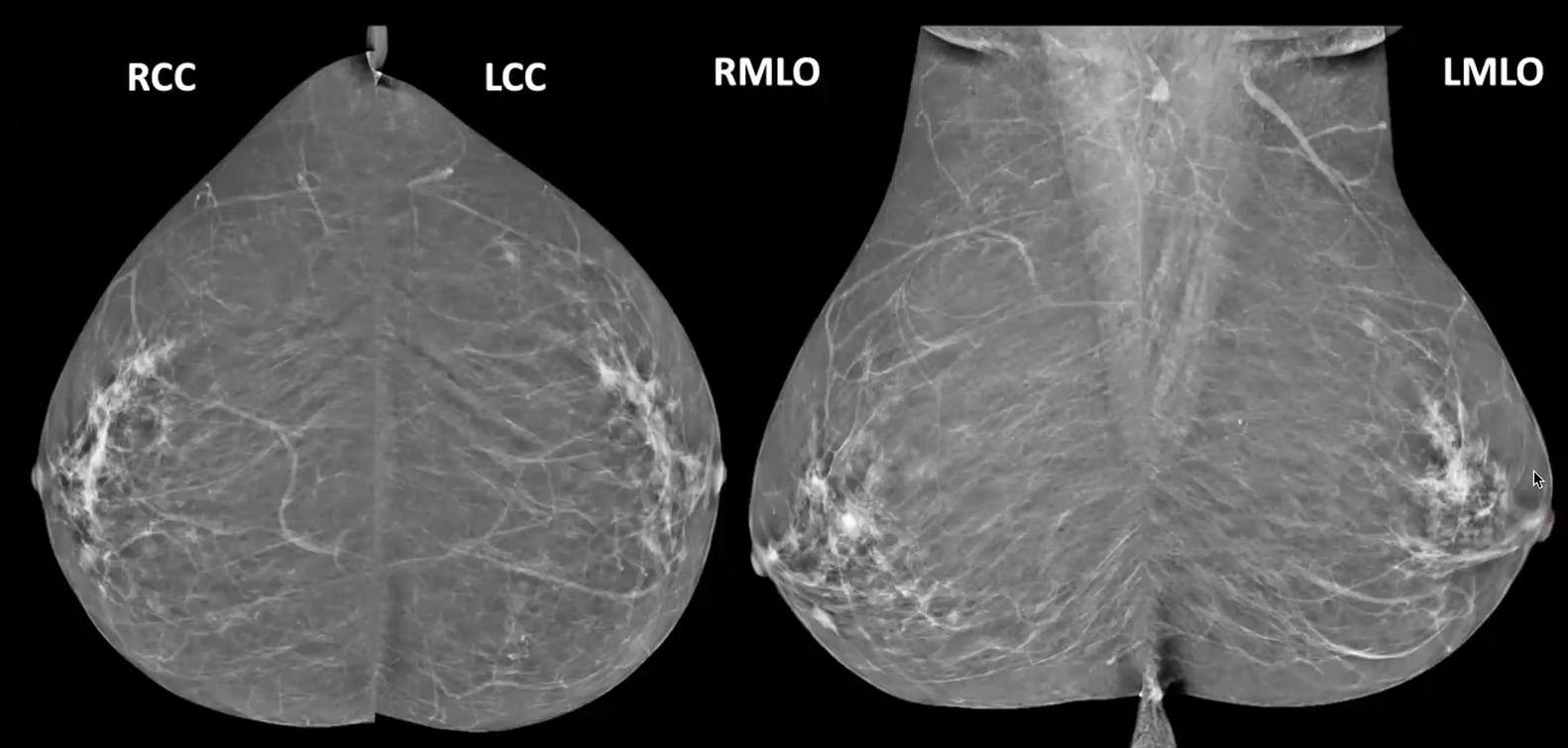 mammogram views.png