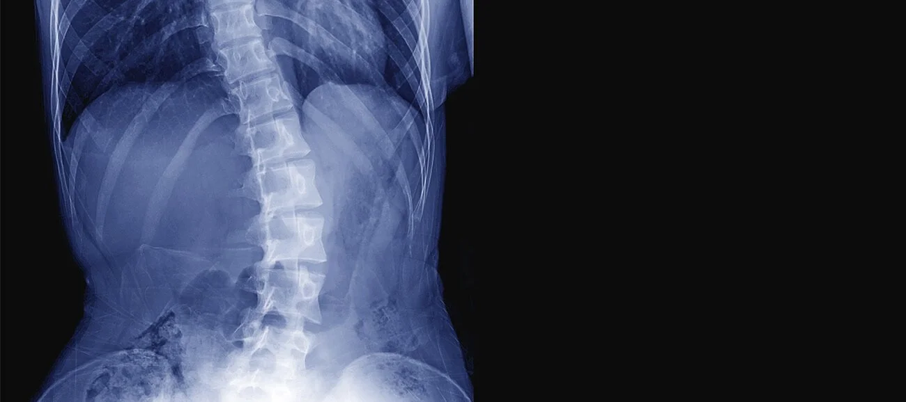 How Does Physiotherapy Help with Scoliosis?