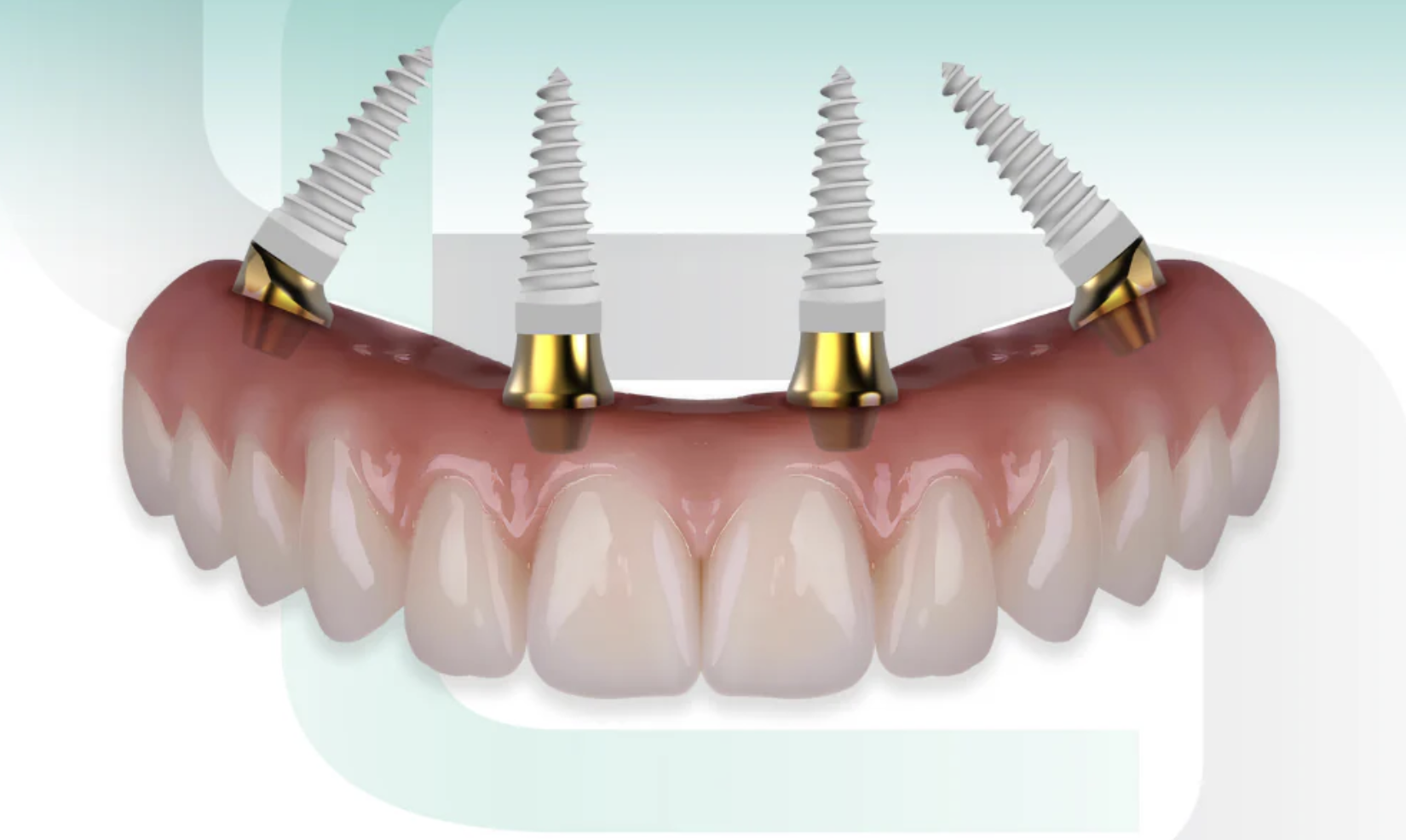 Dental Implants in Costa Rica: Safety, Clinical Standards, and Long-Term Results