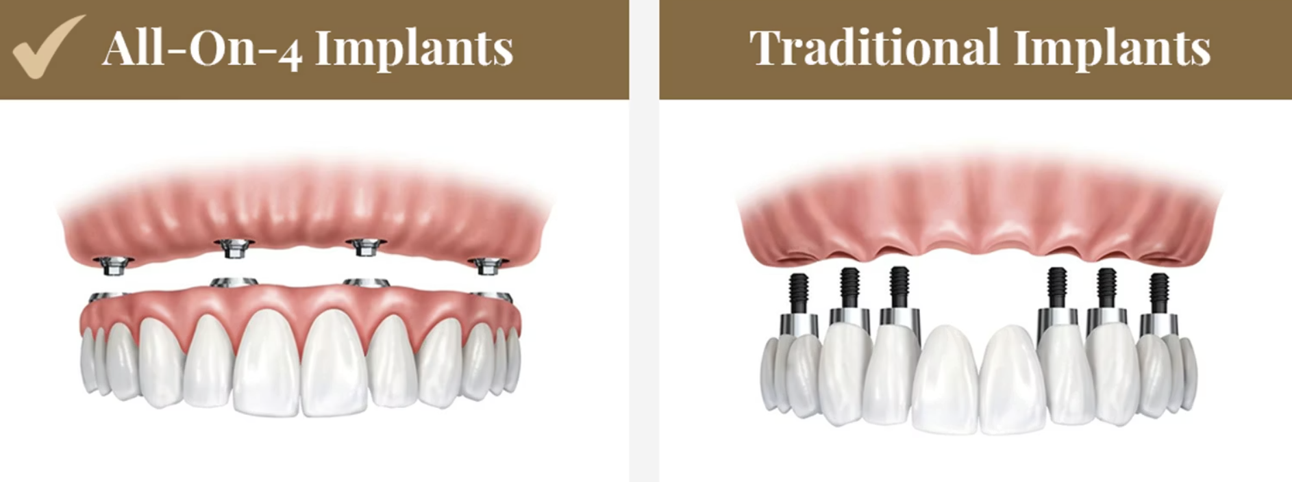 All-on-4 vs Traditional Implants: What International Patients Should Know Before Deciding