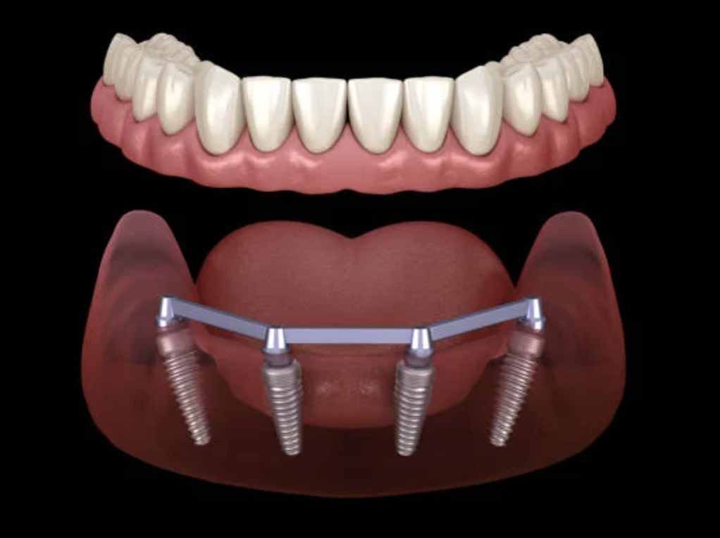 Types of Dental Implants: A Complete Guide for Patients Considering Dental Implants in Costa Rica