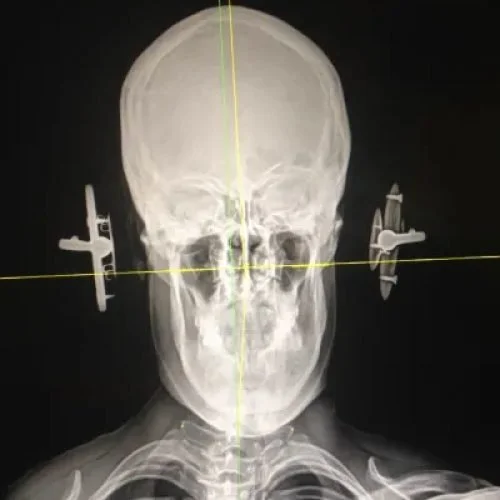 What Causes an Atlas Misalignment ? — Summit Chiropractic & Wellness