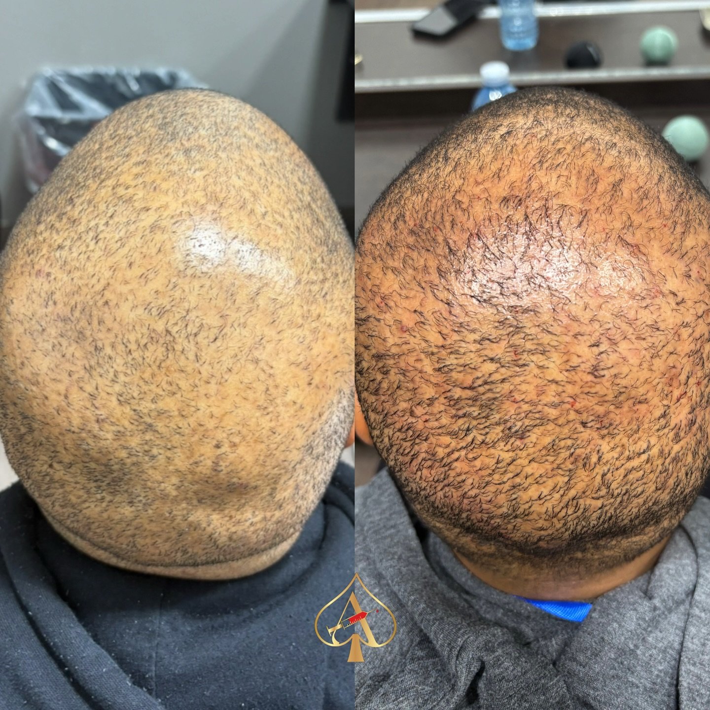 ✨ Results after just ONE PRF hair treatment?! ✨ Yes &mdash; it&rsquo;s that real.

PRF (Platelet-Rich Fibrin) is your body&rsquo;s natural growth factor magic, working to restore thinning hair, stimulate dormant follicles, and promote long-term regro