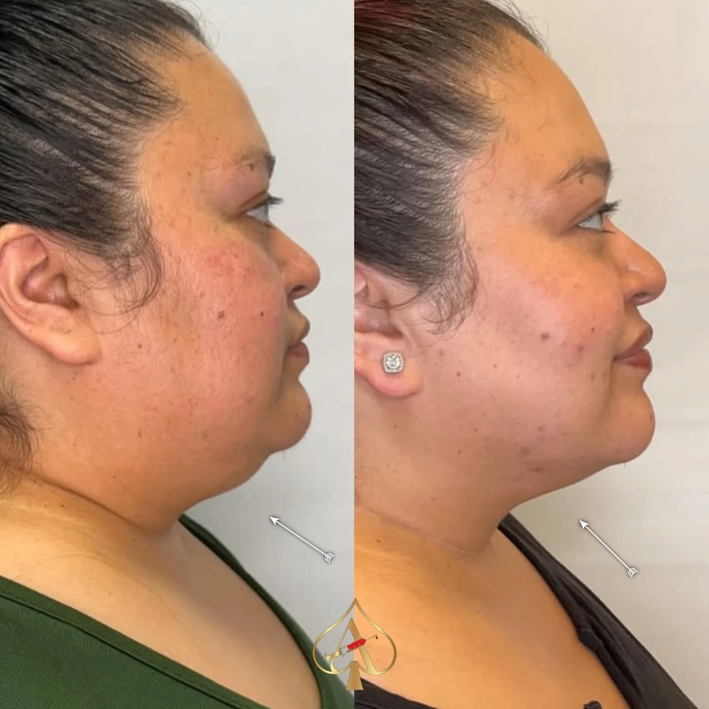 Eliminate that double chin PERMANENTLY 💉 

PCDC (Phosphatidylcholine and Deoxycholate) fat dissolving injections are a non-surgical cosmetic procedure that is used to reduce localized pockets of fat in the body, particularly in areas that are resist