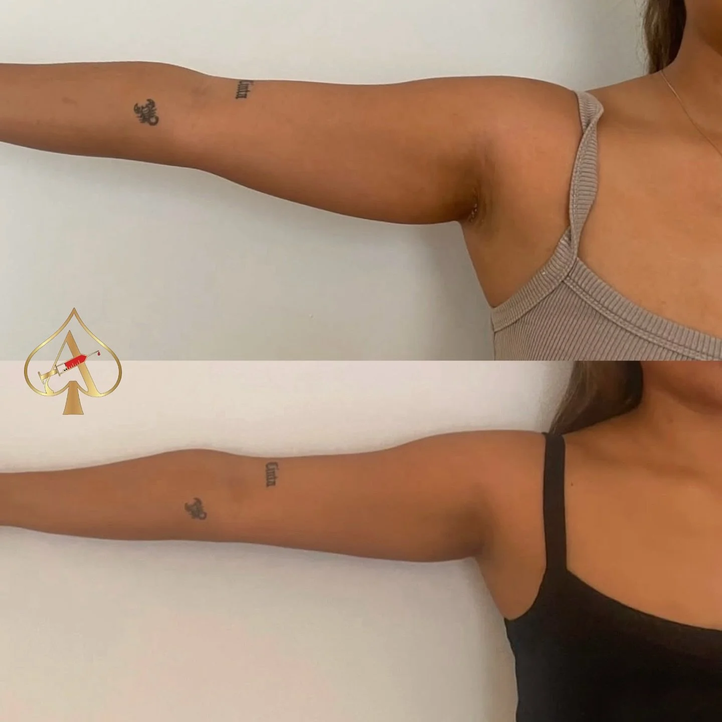 Tired of tucking your arms in every photo? 👀
Let&rsquo;s change that &mdash; for good!

Our PCDC fat dissolving treatment targets stubborn arm fat that just won&rsquo;t budge, no matter how clean you eat or how many workouts you power through.

💉 T