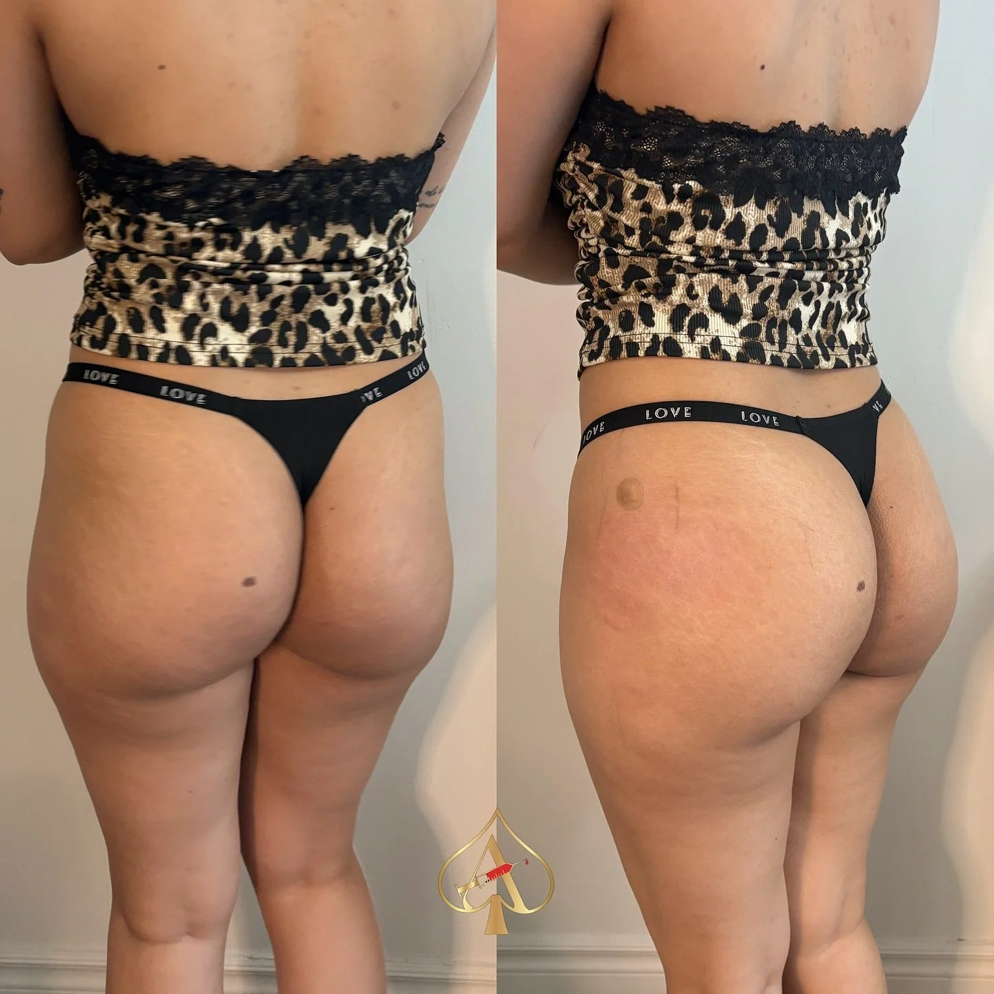 🎤 ⬇️.

&mdash; Immediate, noticeable results
&mdash; Minimal downtime
&mdash; A custom contour based on your body goals
&mdash; A safer, reversible alternative to surgery

No scalpels. No scars. Just strategic artistry.
We believe beauty should enha
