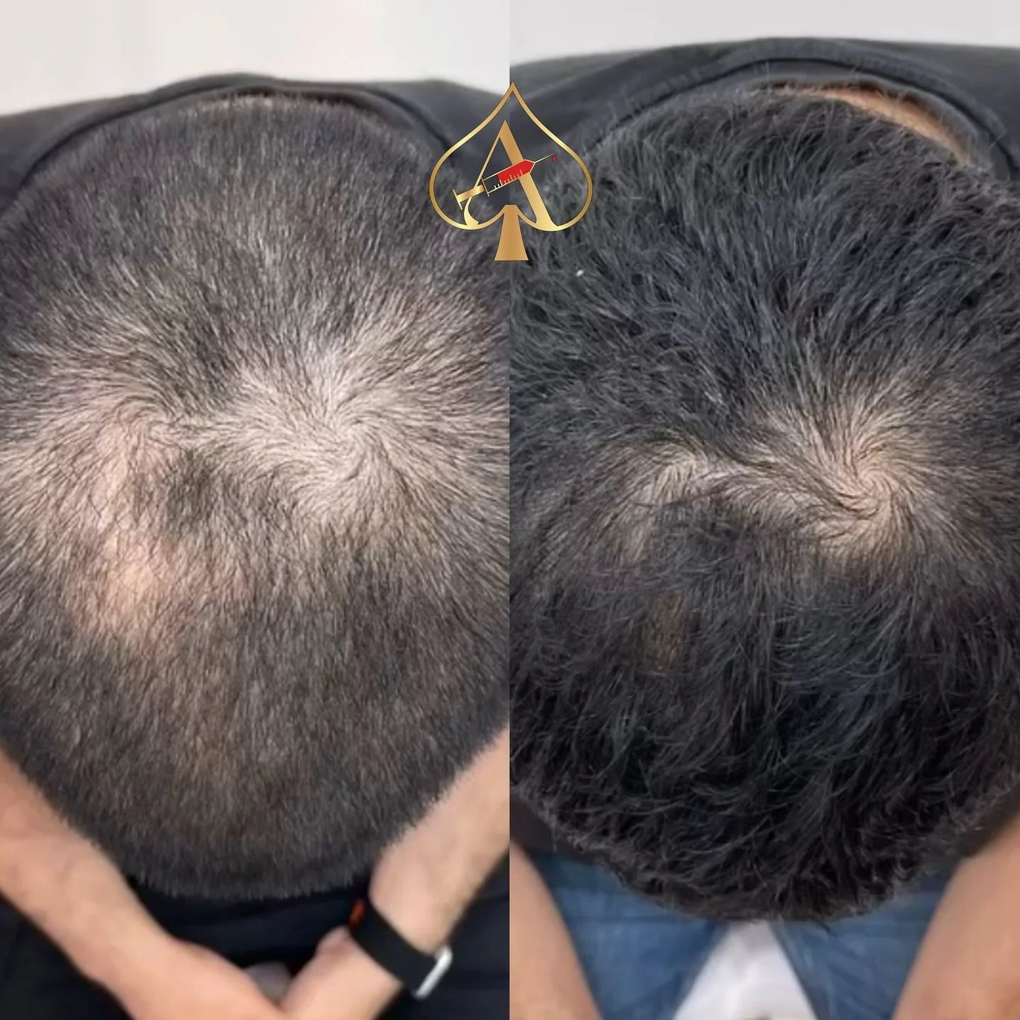 NATURAL way to promote hair restoration 🌱 

PLATELET- RICH FIBRIN &bull; PLATELET-RICH PLASMA

✅ Increase hair density
✅ Promote hair growth
✅ Reduce hair loss &amp; thinning
✅ Improve scalp health
✅ Reduce hair fallout &amp; more!

PRF (similar to 