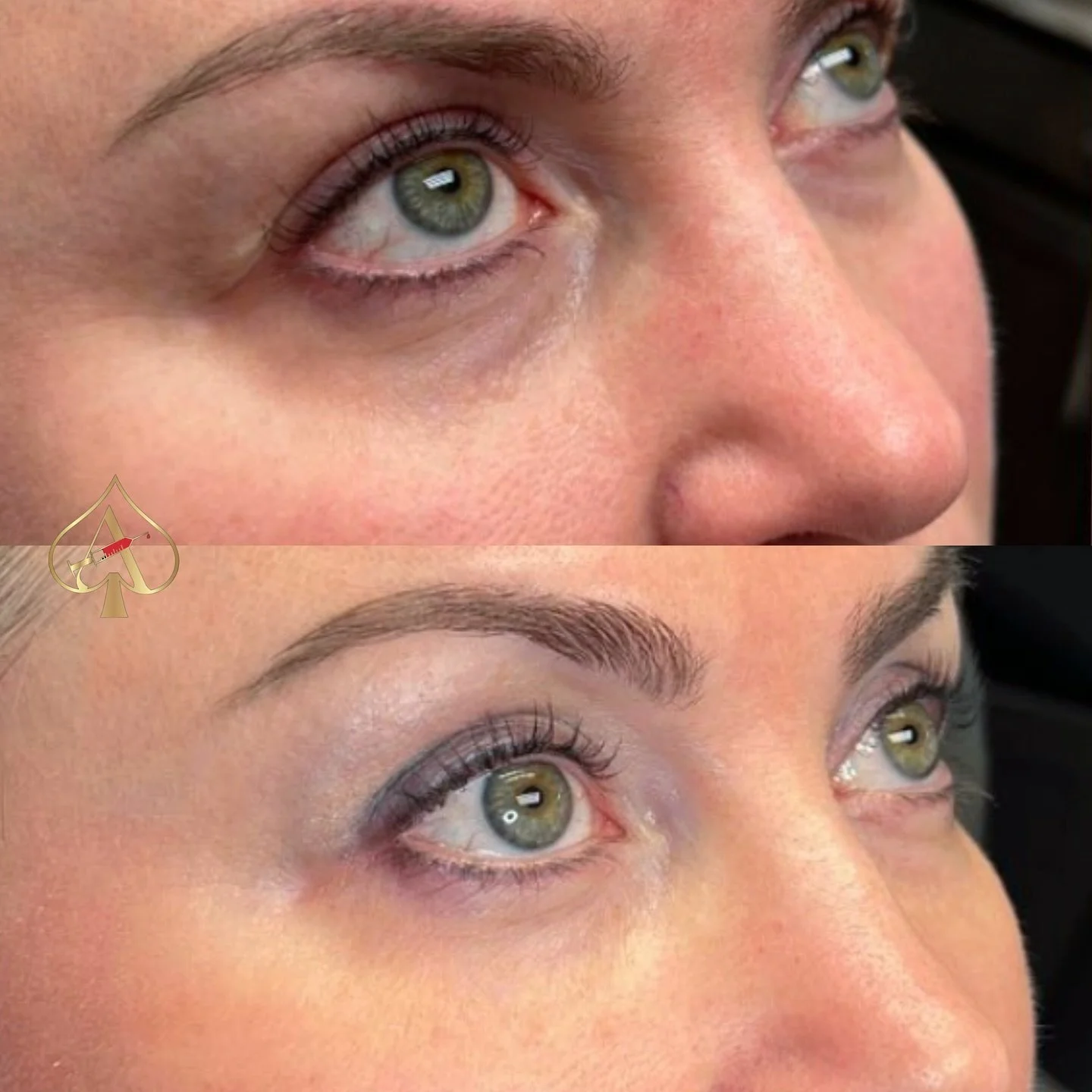 Say goodbye to tired eyes with Biofiller for under-eye rejuvenation! ✨ 

Unlike traditional dermal fillers, Biofiller uses your body&rsquo;s own regenerative powers to restore volume and smoothness under the eyes, delivering immediate, natural-lookin