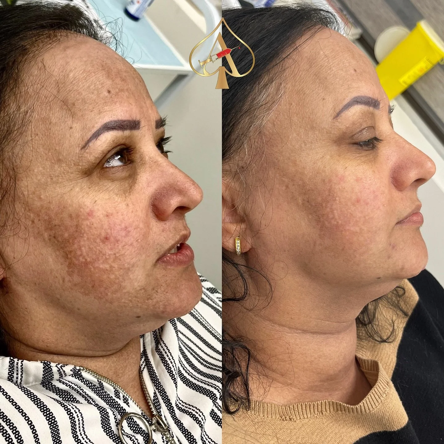 Hyperpigmentation reduction with only TWO treatments of PRF 💉. We cannot wait to see how the improvement continues! 😻

&bull; PRF - Skin Rejuvenation &bull;

PRF is a natural treatment that takes plasma rich platelets from your own blood and stimul